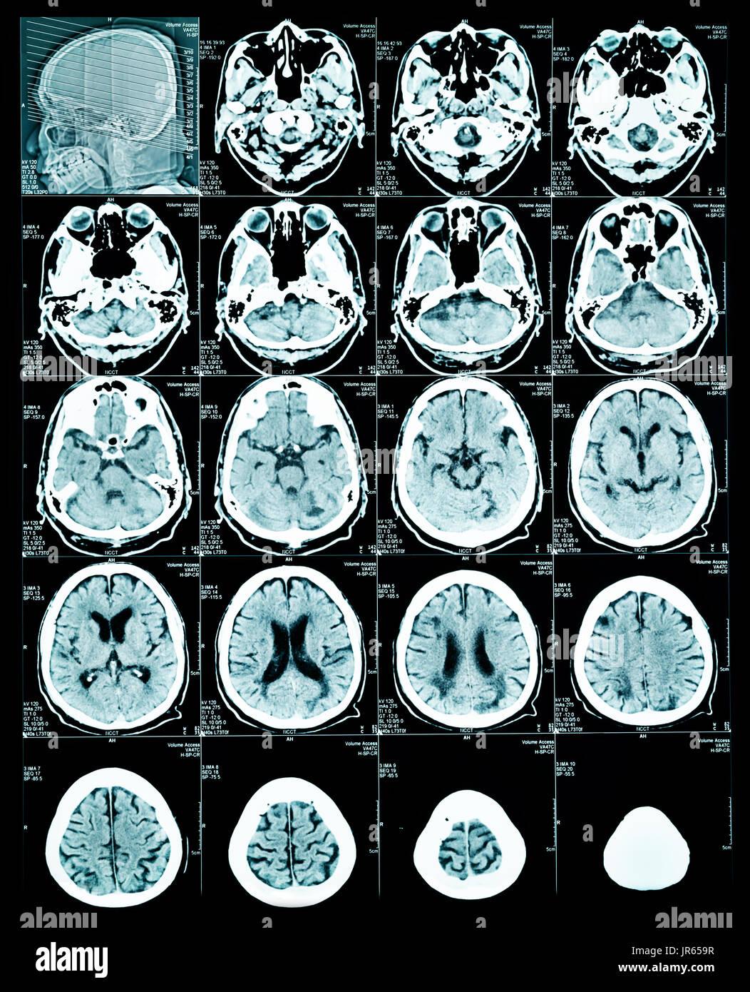 Mrt-Scan des Gehirns, der für die Diagnose Stockfoto