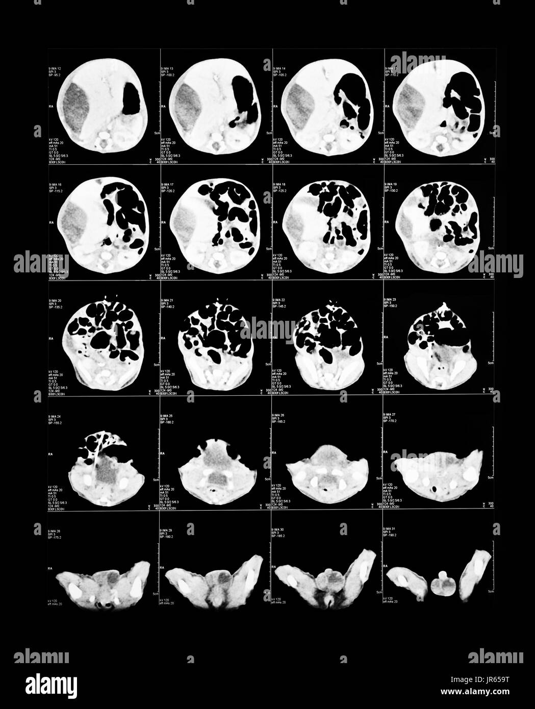 X-ray Image des Gehirns Computertomographie (Gehirn) Stockfoto
