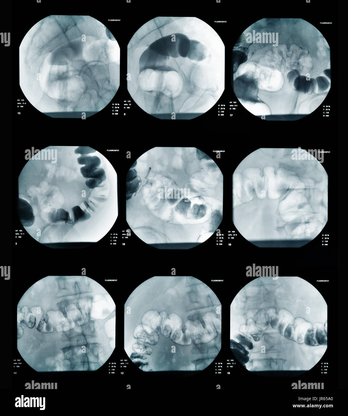 Bild der intestinalen abdominal Xray Stockfoto