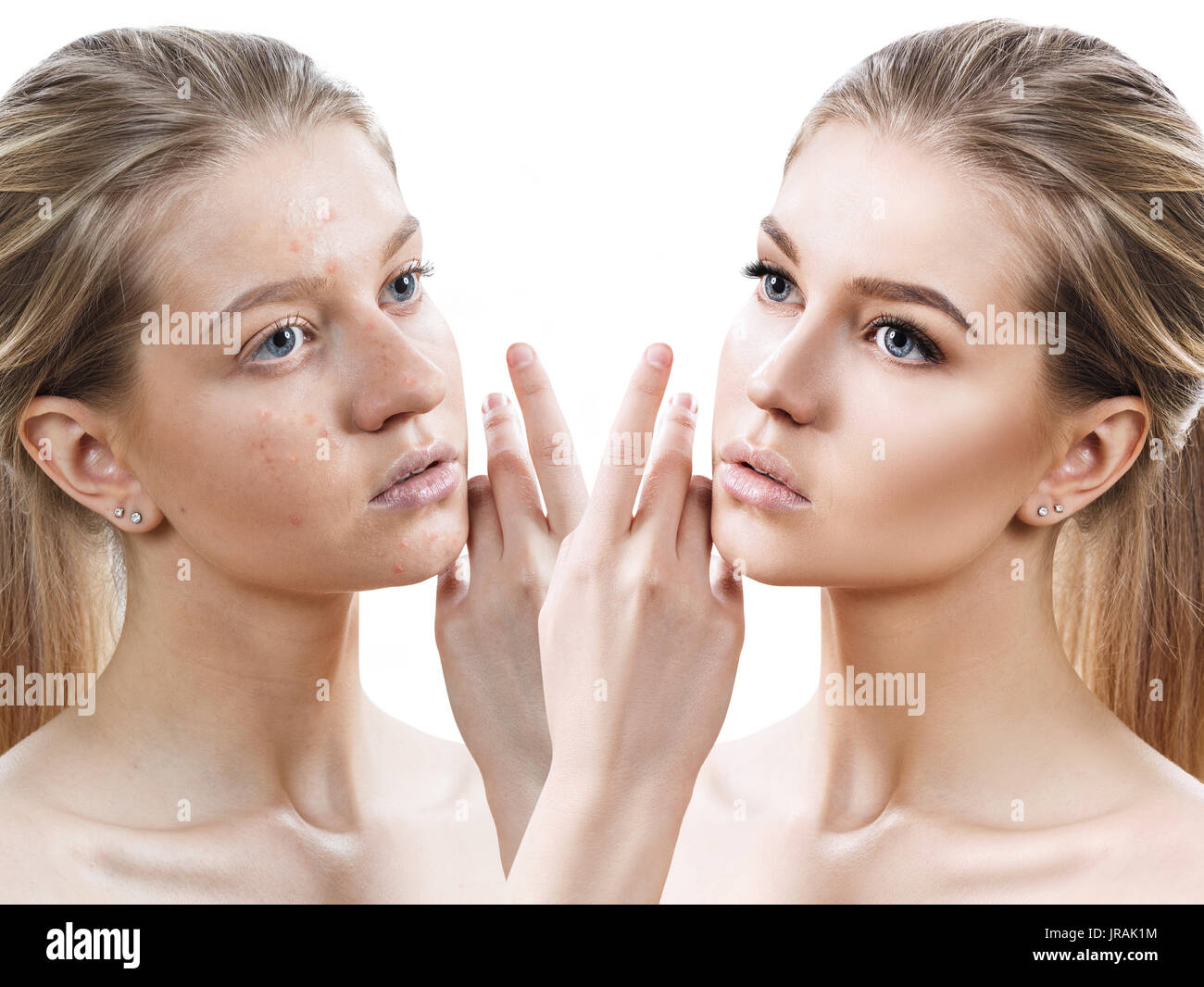 Mädchen mit Akne vor und nach der Behandlung Stockfoto