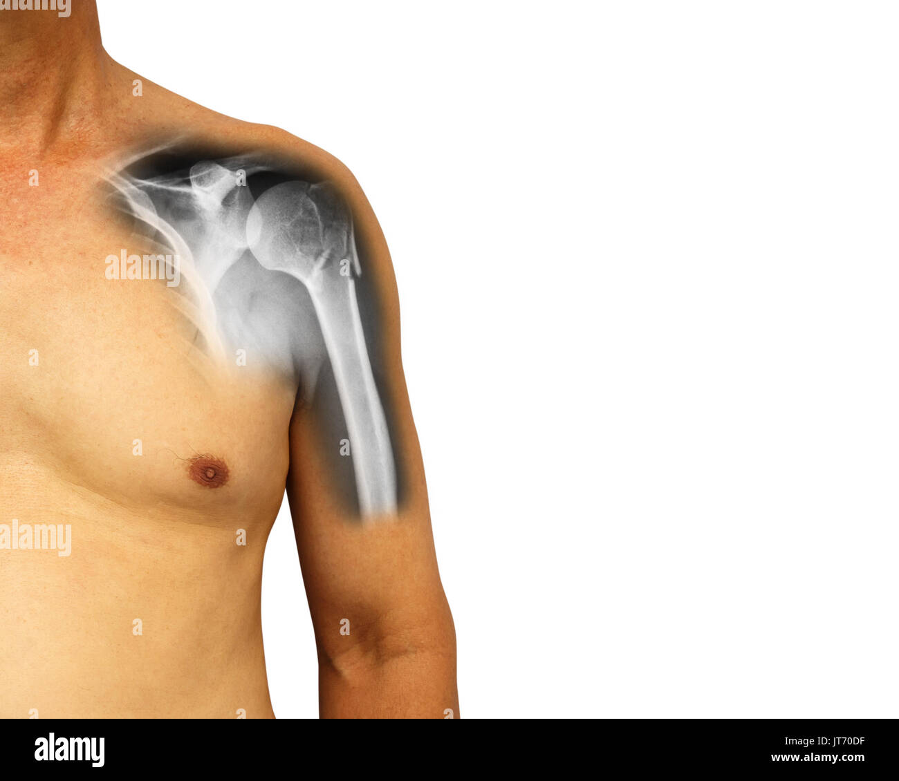 Menschliche Schulter mit x-ray Bruch am Hals des Humerus (Arm). Isolierte Hintergrund. Leeren Bereich auf der rechten Seite. Stockfoto