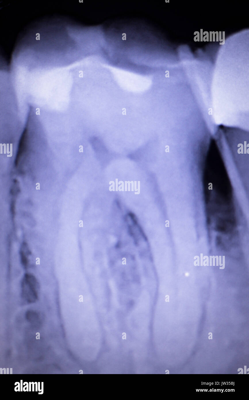 Dental xrayScan der Zahn mit Krone füllen und Wurzelbehandlung Infektion Entzündung der