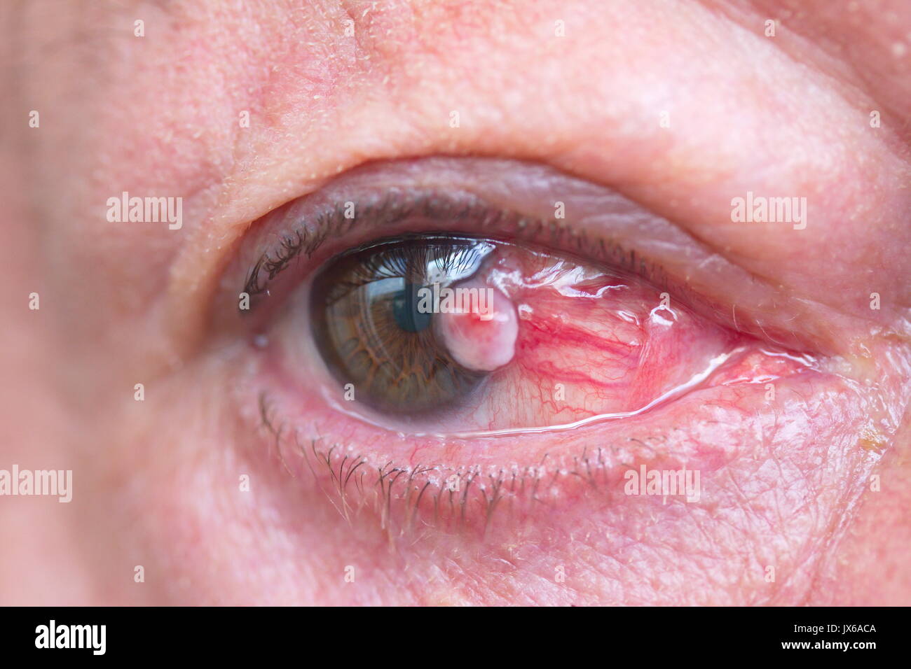 Nahaufnahme des Auges bindehaut Plattenepithelkarzinom Stockfoto