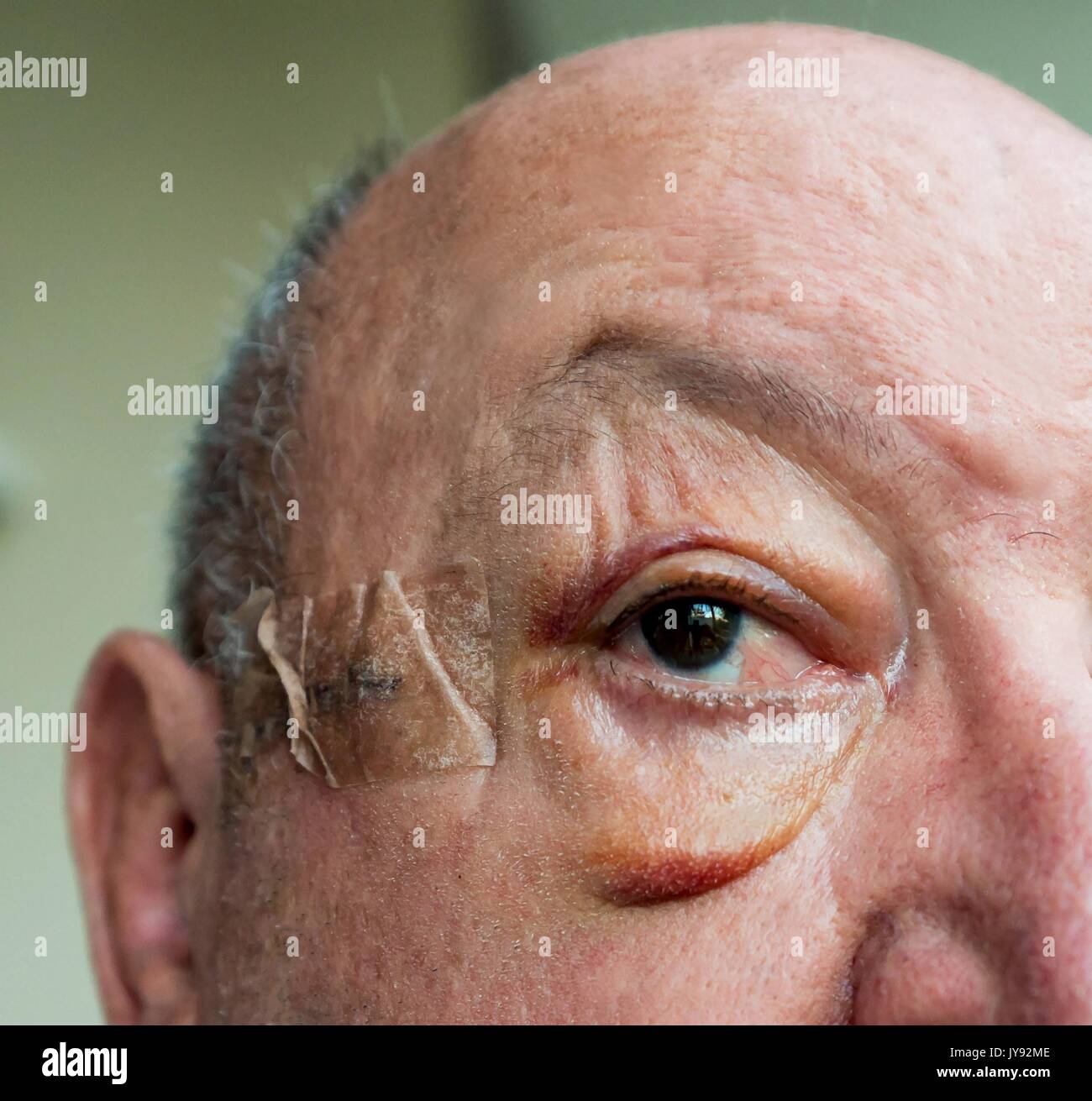 In der Nähe von älteren Mann Gesicht mit großen Schwellung der Augenlider nach der Operation. Stockfoto