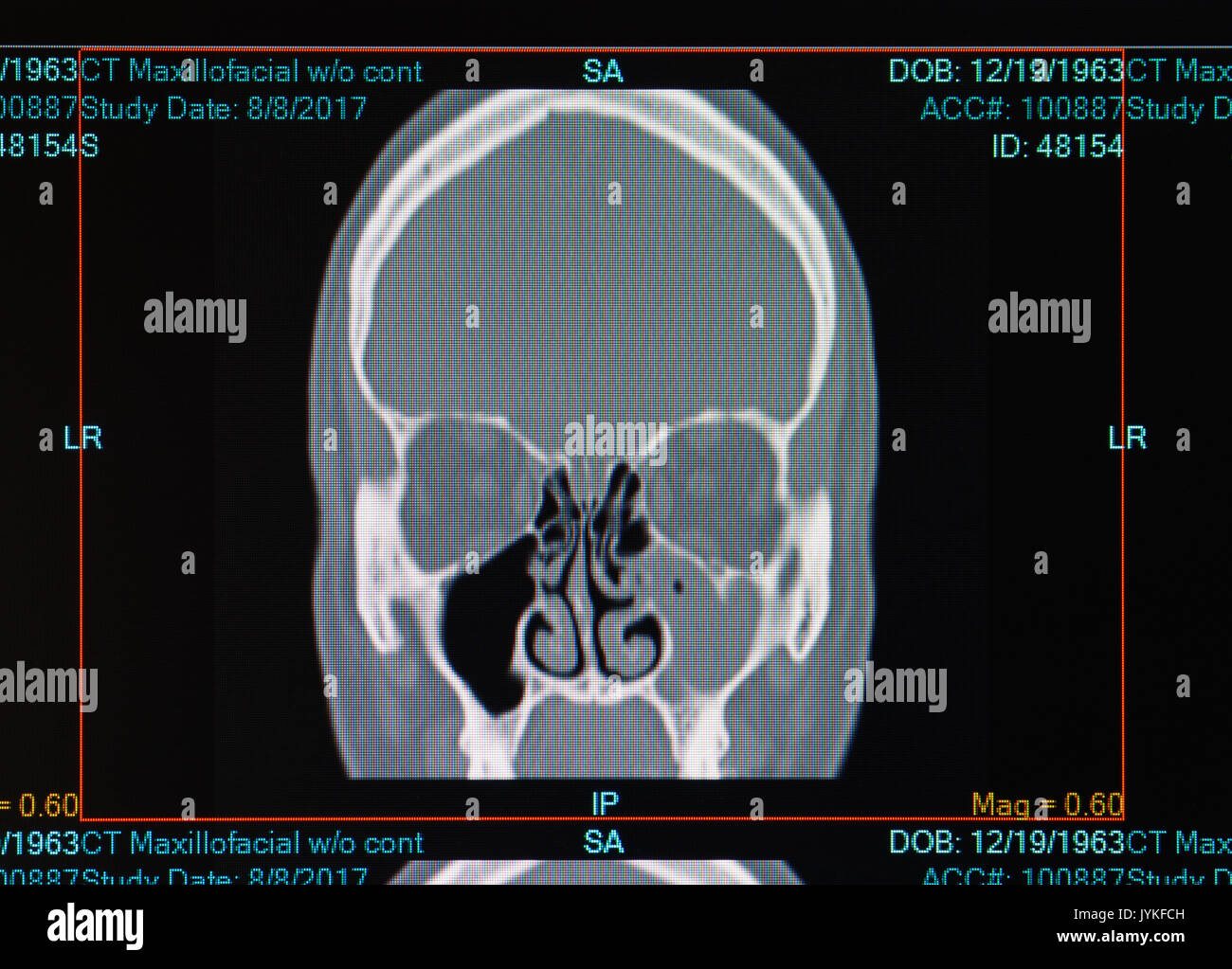 CT-Scan der männlichen mit nasennebenhöhlenentzündung (Sinusitis) Befüllung der linken Kieferhöhle. Deckt auch abgewichen Septum Stockfoto