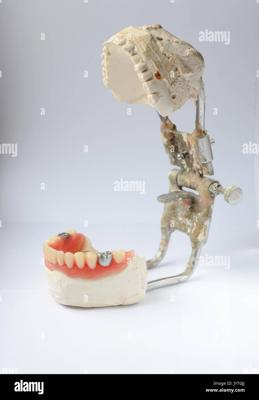 Künstliche Zähne, Zahnersatz mit falschen Zahn, metallic silber Krone an  Zahn. Zahnersatz Stockfotografie - Alamy