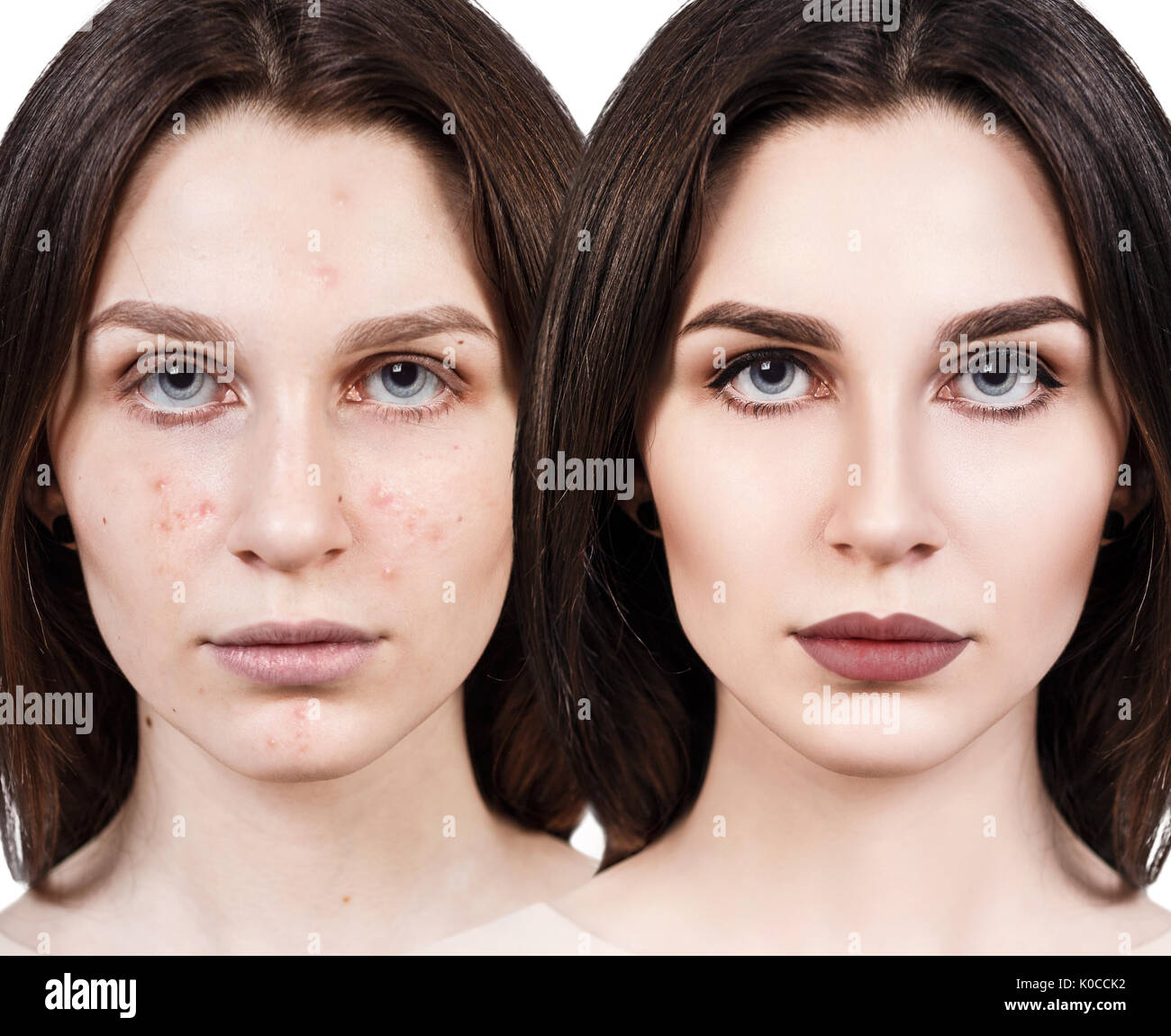 Mädchen mit Akne vor und nach der Behandlung Stockfoto