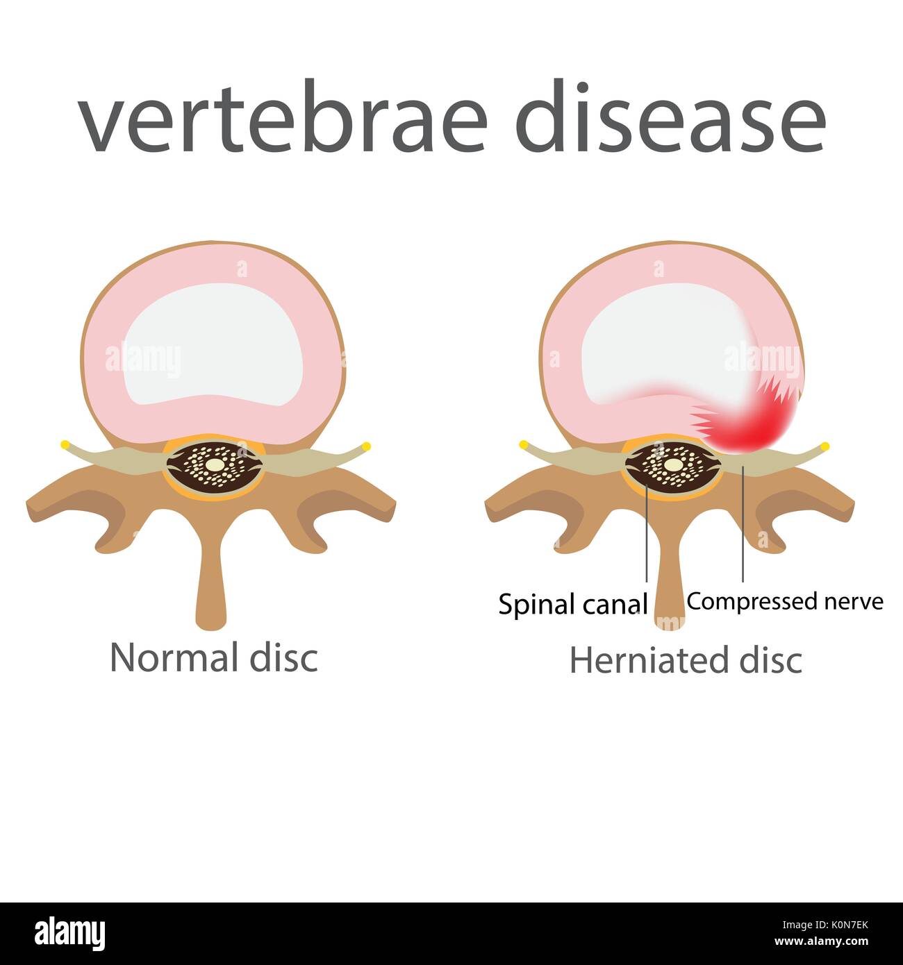 Rückenschmerzen. spin Stenose. Wirbel Krankheit Vektor Format Stock Vektor