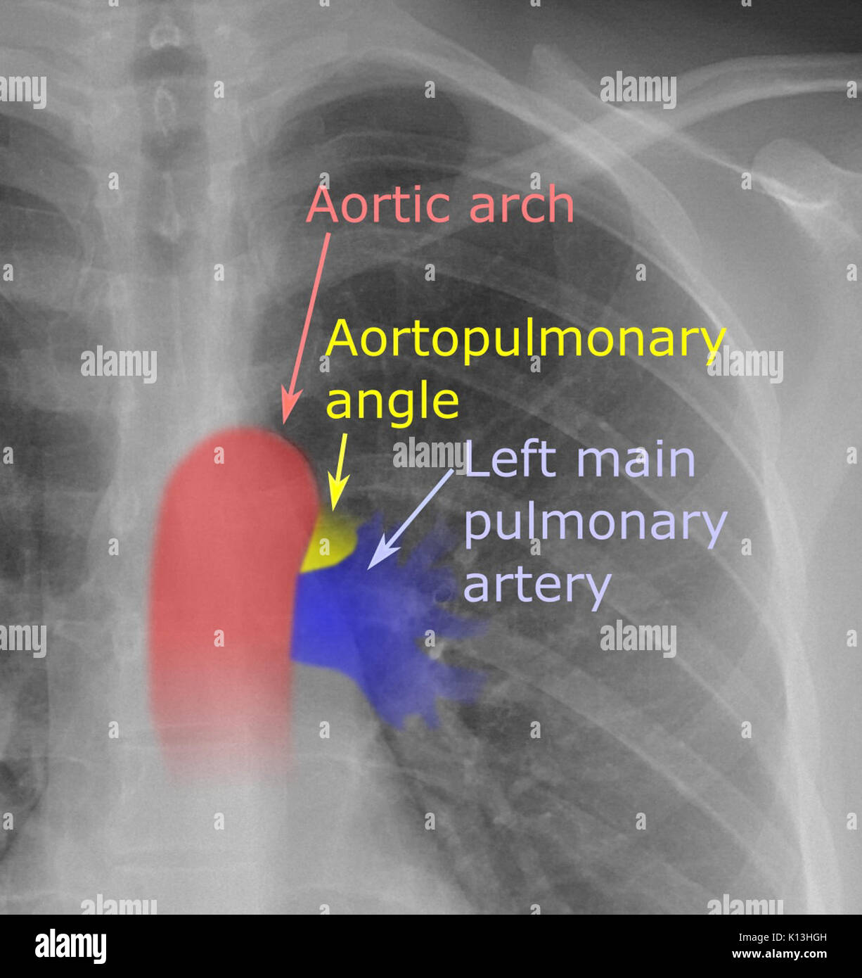 Aortopulmonary Winkel Stockfoto