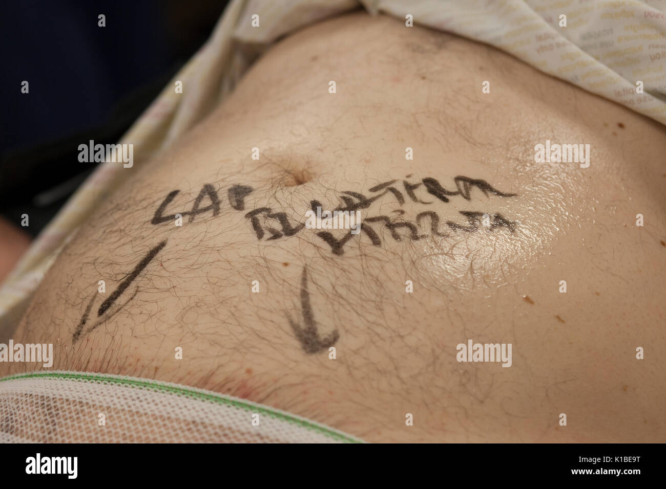 Hernia Operation Stockfotos & Hernia Operation Bilder Alamy