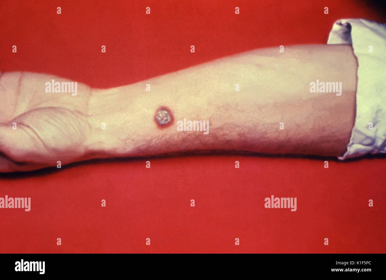 Anthrax, Haut des linken Unterarms. Kutane Anthrax-Läsion am linken Unterarm eines weißen Mannes. Mit freundlicher Genehmigung von CDC. 1990. Stockfoto