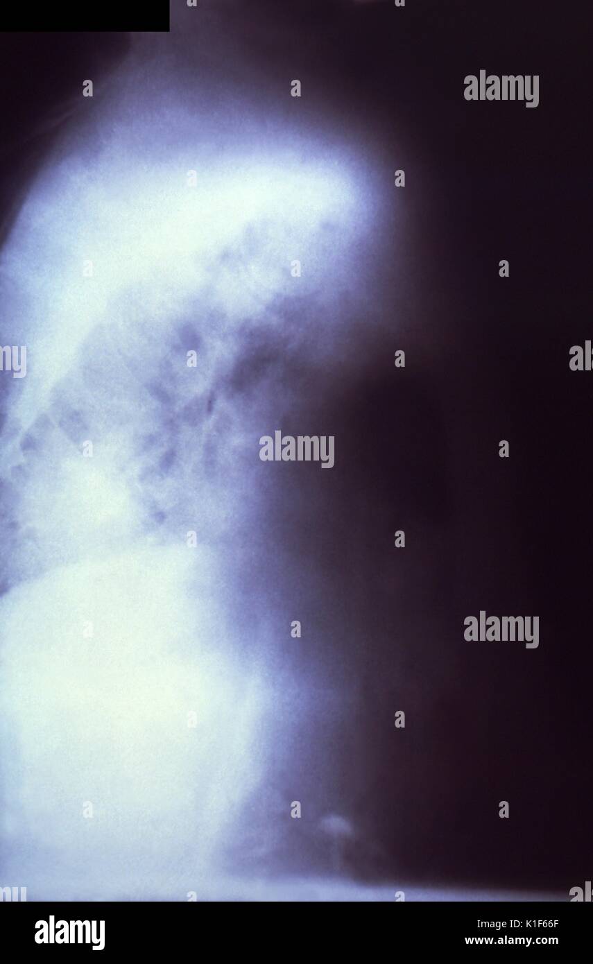 Diese rechts-laterale Thorax-Röntgenaufnahme zeigte 13 Tage nach der Exposition des Patienten mit dem Bazillus, Bacillus anthracis, der Ursache der als Anthrax bekannten Krankheit, Hinweise auf eine pulmonische Infektion. Alle Arten von Anthrax können verhindert und mit Antibiotika behandelt werden. Es gibt einen Impfstoff, der zur Vorbeugung von Anthrax zugelassen ist, aber er wird nur für die routinemäßige Anwendung in bestimmten Gruppen von gefährdeten Erwachsenen empfohlen. Wenn jemand Symptome von Anthrax hat, ist es wichtig, medizinische Versorgung so schnell wie möglich zu erhalten, um die besten Chancen auf eine vollständige Genesung zu haben. Mit freundlicher Genehmigung von CDC/Sidney J. Brodsky, 1966. Stockfoto