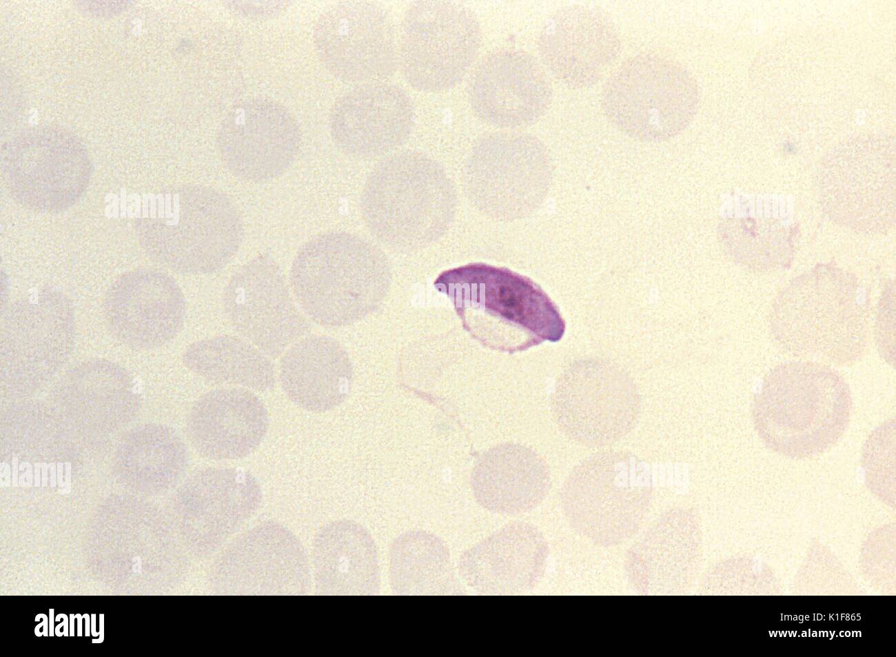 Diese thin film Giemsa-befleckte Schliffbild zeigt eine parasitäre Plasmodium falciparum microgametocyte. Infektion mit einer Art von Malaria, P. falciparum, wenn sie nicht sofort behandelt, Nierenversagen führen kann. Schwellung des Bauches, Augen, Hände und Füße sind einige der Symptome der nephrosis auf durch die beschädigten Nieren gebracht. Bild mit freundlicher Genehmigung von CDC/Dr. Melvin, Steven Glenn, 1973. Stockfoto