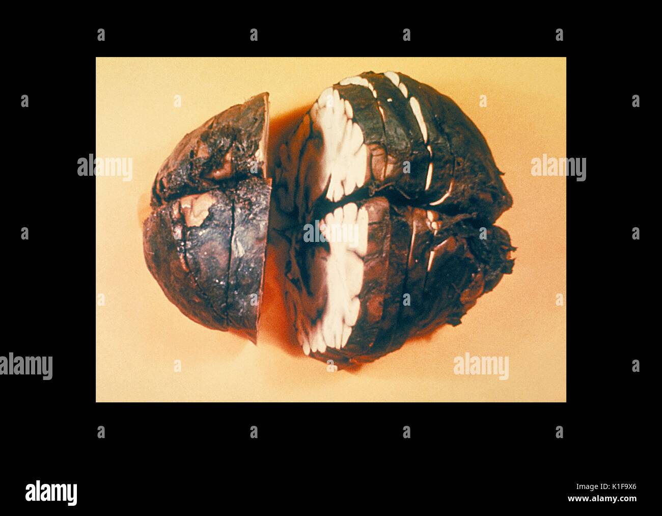 Grobe Pathologie von Festen, schneiden Gehirn zeigt hämorrhagische Meningitis durch Milzbrand mit freundlicher Genehmigung CDC, 1966 zum Einatmen. Stockfoto