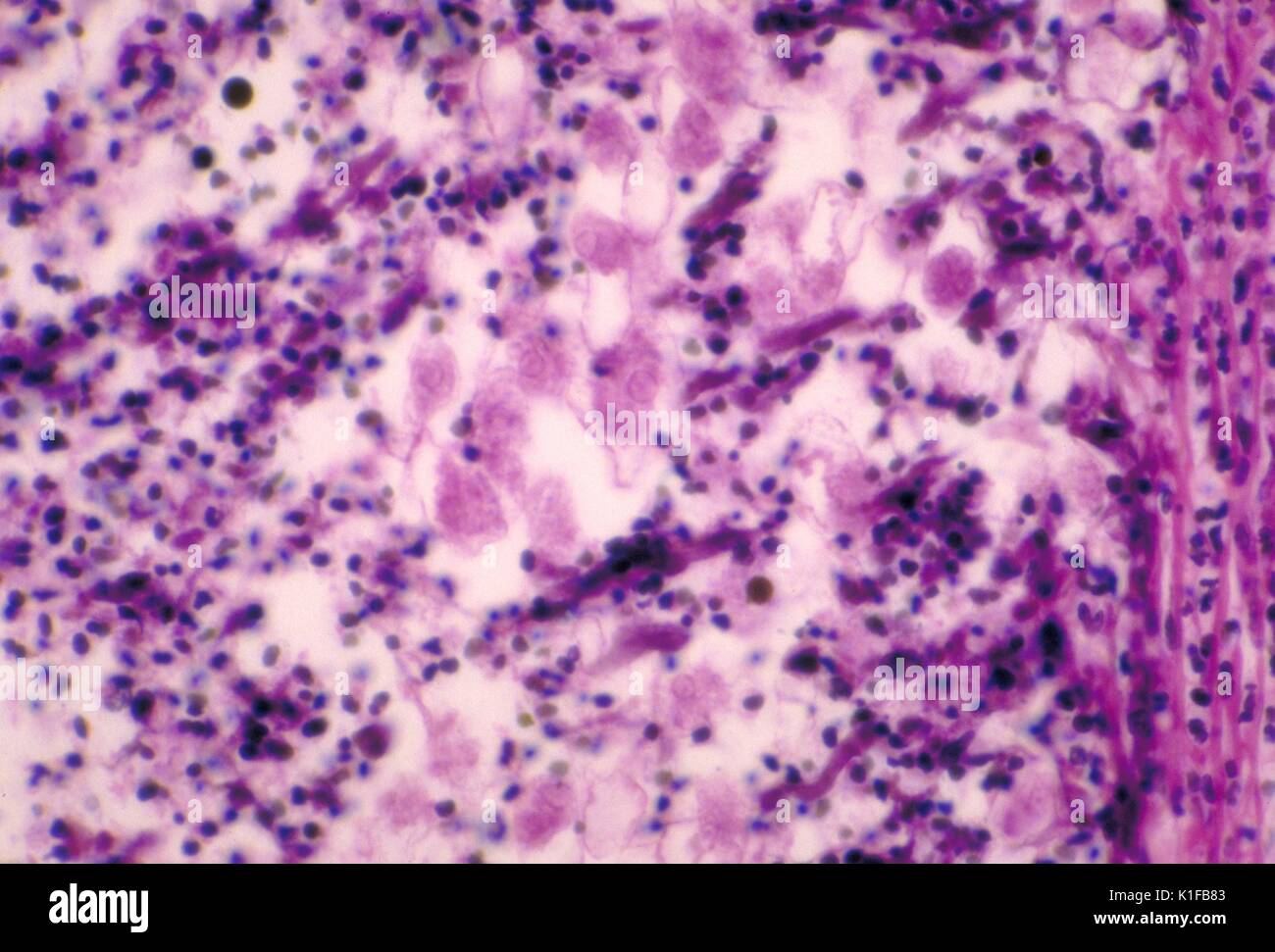 Diese histopathologic photomicrograph zeigt die Merkmale der in einem darmgeschwür gefunden, belegt mit Zahlen von parasit Entamoeba histolytica trophozoite - inszenierte Amöben. Bild mit freundlicher Genehmigung von CDC/Dr. Mae Melvin, 1982. Stockfoto
