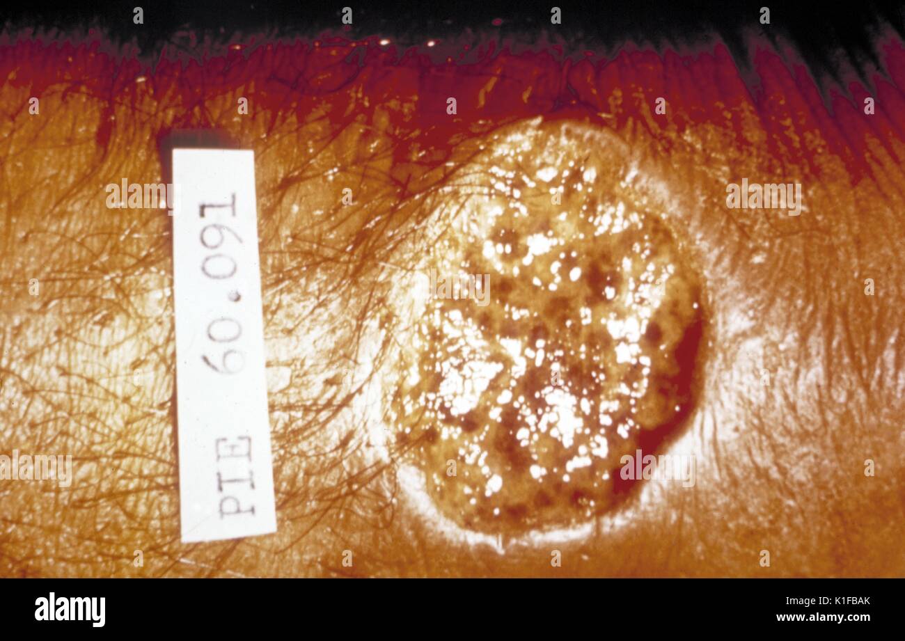 Leishmaniose mensch Fotos und Bildmaterial in hoher Auflösung Alamy