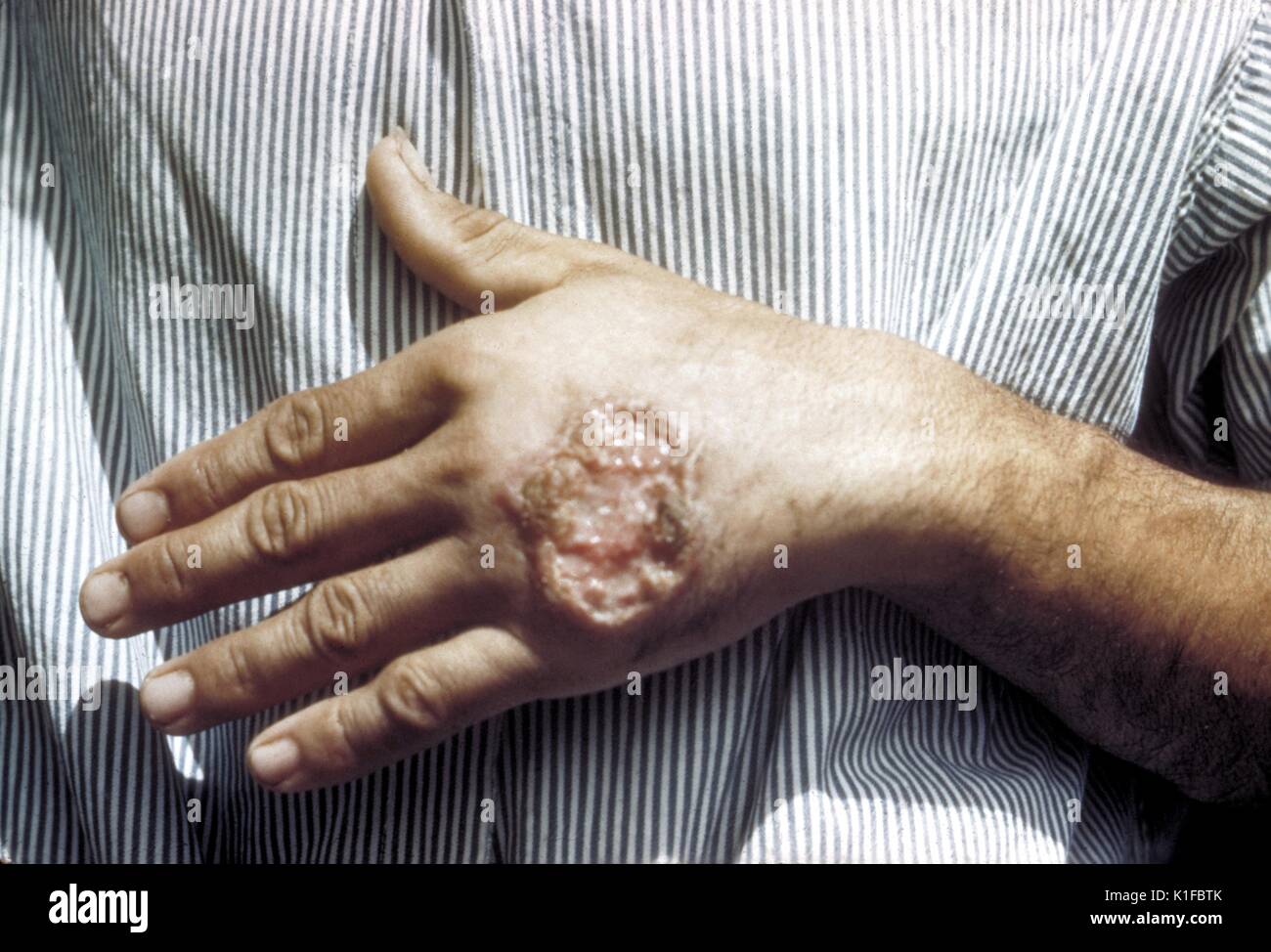 Hautgeschwüre aufgrund der Leishmaniose, Hand des zentralen amerikanischen Erwachsenen. Bild mit freundlicher Genehmigung von CDC/Dr. D.S. Martin. 1981. Stockfoto