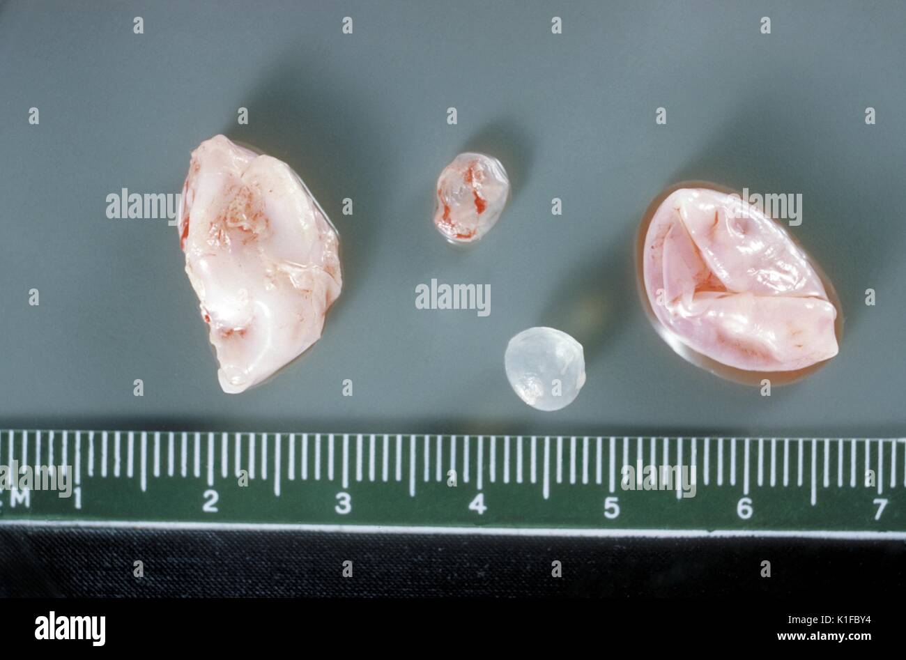 Grobe Pathologie von Membran und hydatid Tochter Zysten aus menschlichen Lunge. Parasiten. Bild mit freundlicher Genehmigung von CDC/Dr. I. Kagan, 1961. Stockfoto