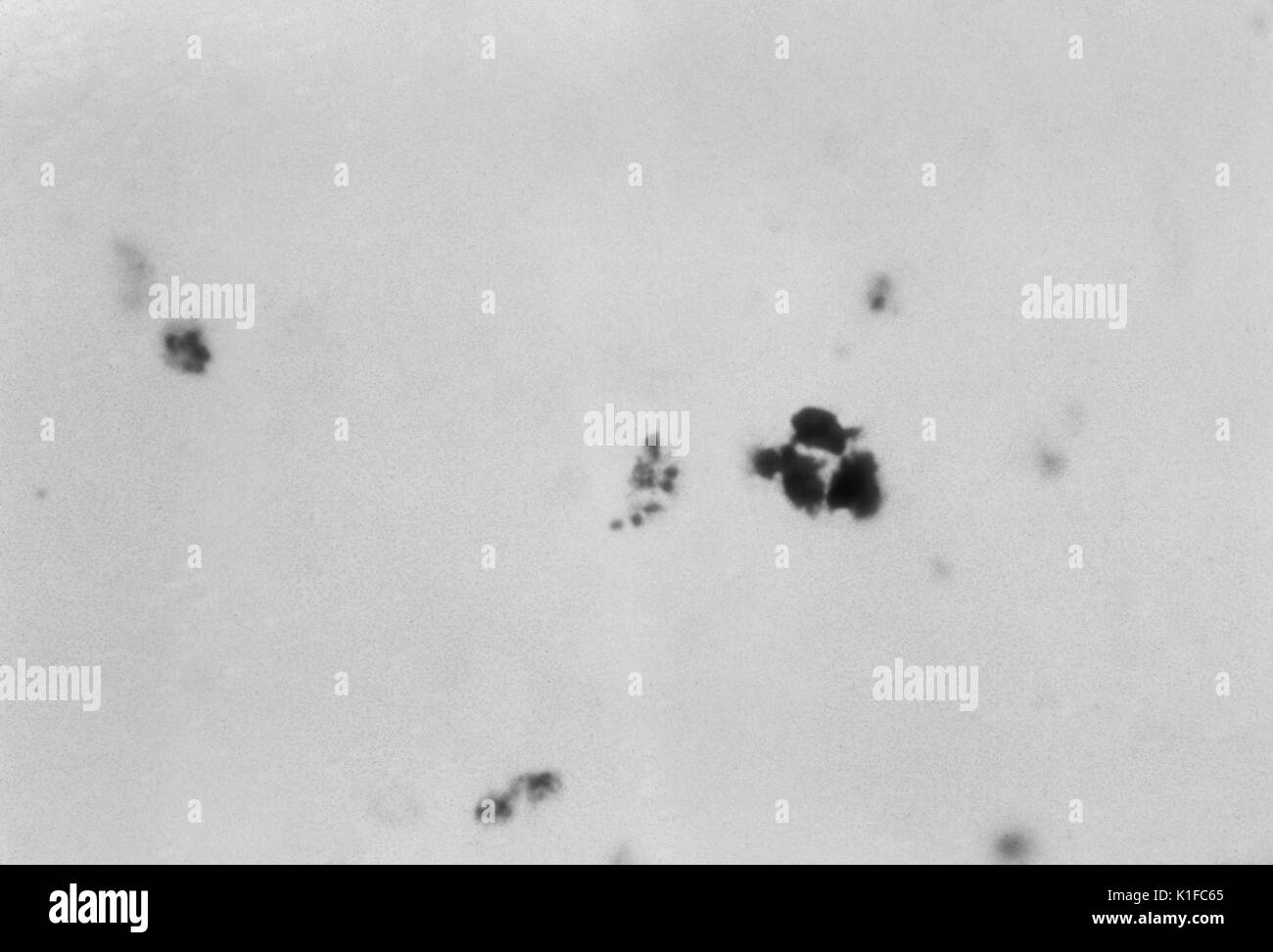 Plasmodiumsorten, reifer schizont, wenig Zytoplasma ist sichtbar um das Chromatiert Massen von merozoiten. Auch gibt es eine wachsende trophozoite und drei presegmenters sowie eine weiße Blutkörperchen. Malariaparasiten. Bild mit freundlicher Genehmigung von CDC/Dr. N.J. Wheeler, Jr, 1963. Stockfoto
