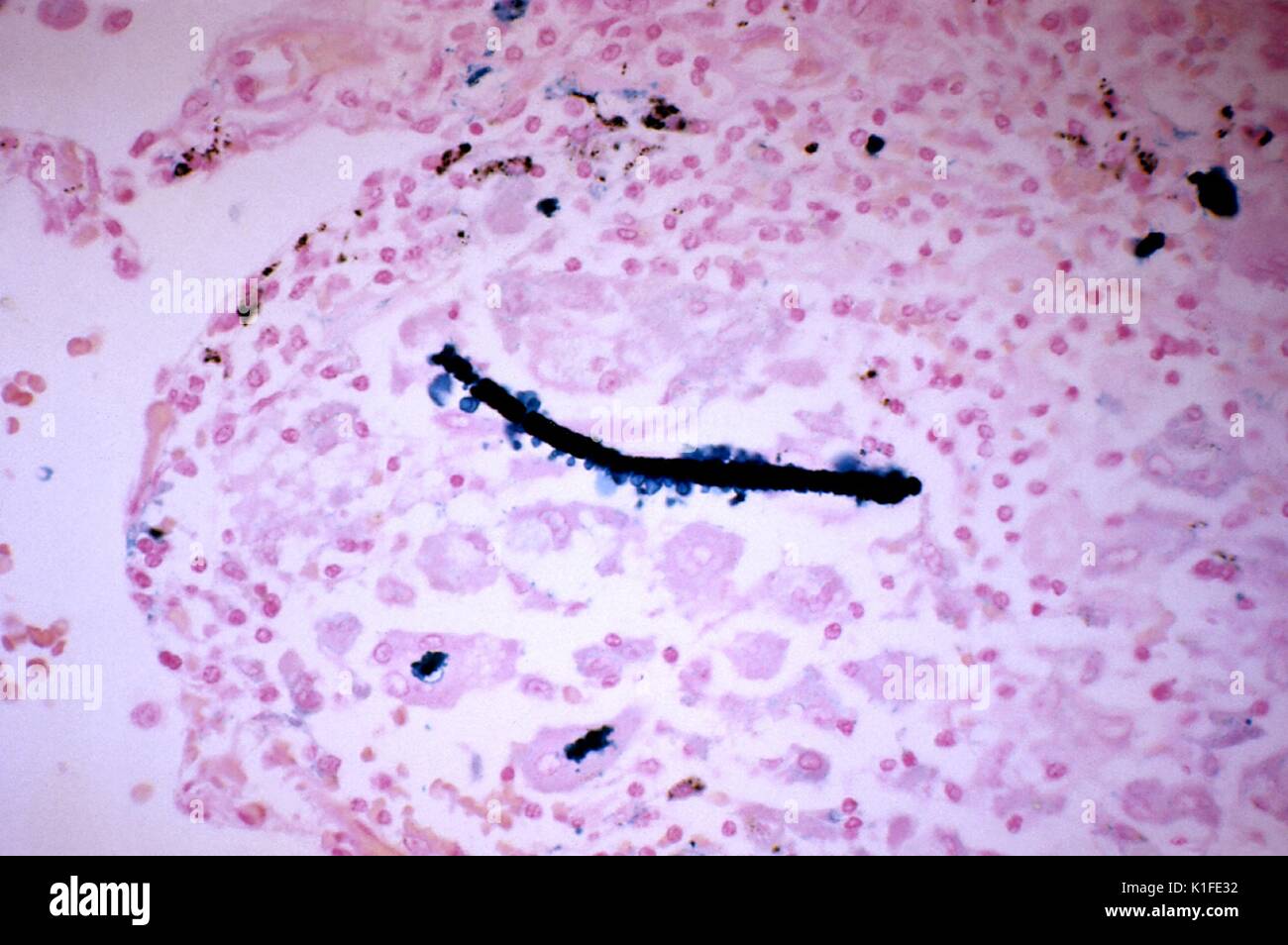 Histopathologie von eisenhaltigen Körper, Lunge, Diese photomicrograph offenbart histopathologic Veränderungen im Lungengewebe Muster gefunden, Anzeigen einer eisenhaltigen Körper. Eine Faser Asbest oder ähnliche Substanz, war überzogen von einer eisernen - Protein Komplex und durch Makrophagen umgeben. Die Probe wurde mit einer Preußischen blaue Fleck verarbeitet. Bild mit freundlicher Genehmigung von CDC/Dr. Edwin S. Ewing, Jr., 1971. Stockfoto