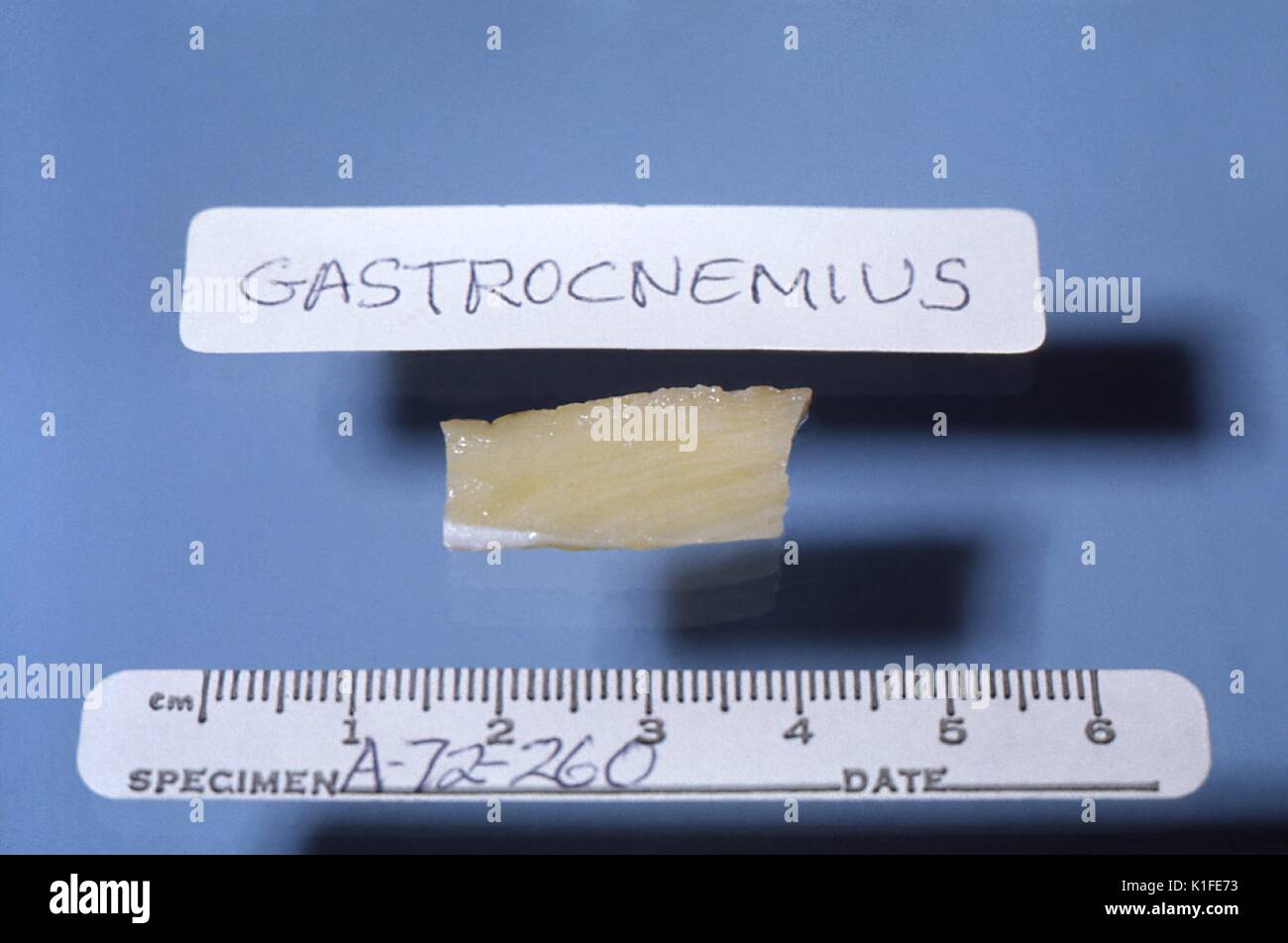 Grobe Pathologie der Skelettmuskulatur in der tödlichen Duchenne Muskeldystrophie, Diese grobe Autopsie Muster des Gastrocnemius muscle Fest von einem Patienten, der pseudohypertrophic Muskeldystrophie starb geerntet wurde, Duchenne Typ. In dieser Form der Krankheit, gelblich-weiße Fett ersetzt in der Regel rötlich-braun der Skelettmuskulatur. Bild mit freundlicher Genehmigung von CDC/Dr. Edwin S. Ewing, Jr, 1972. Stockfoto