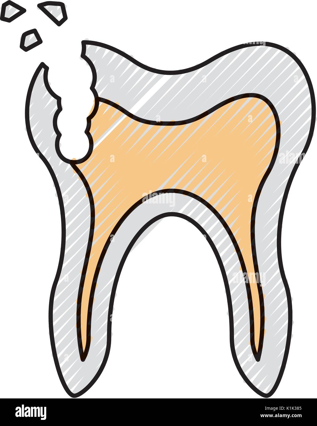 Menschliche Zahn mit Karies Stock Vektor