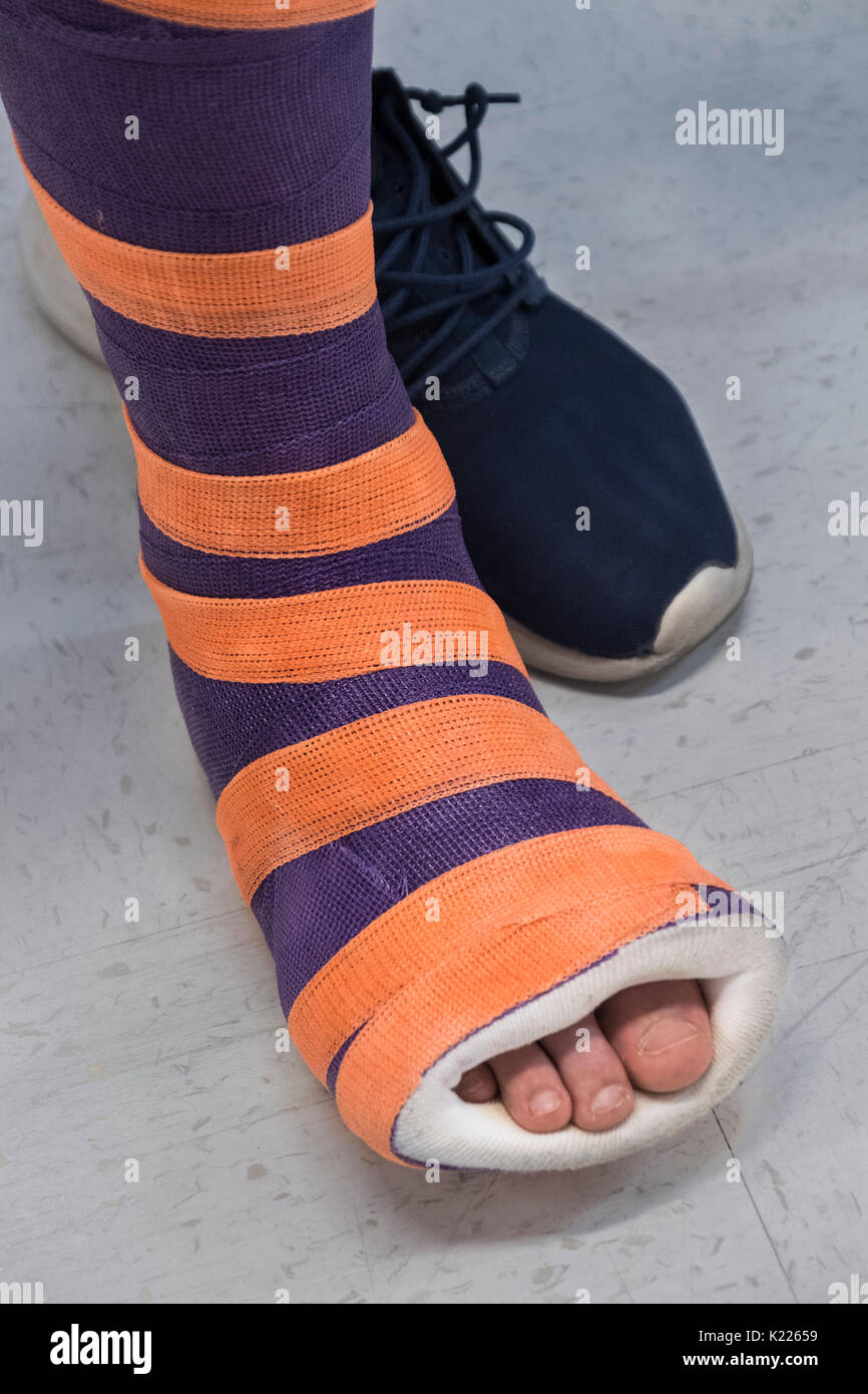 Ein cast auf einem Bein mit orange und lila Streifen. Stockfoto