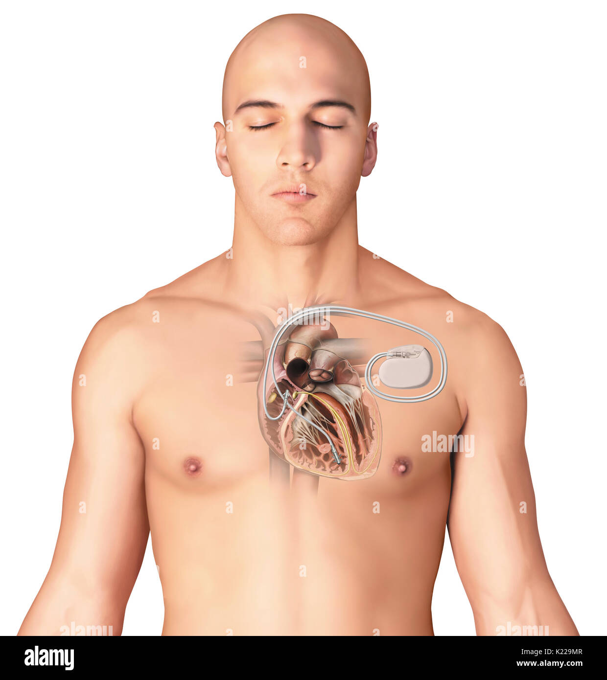 Elektronisches Implantat strahlt, dass ein elektrischer Impuls um einen regelmäßigen Herzrhythmus bei Patienten mit Herz Schaden zu bewahren. Stockfoto