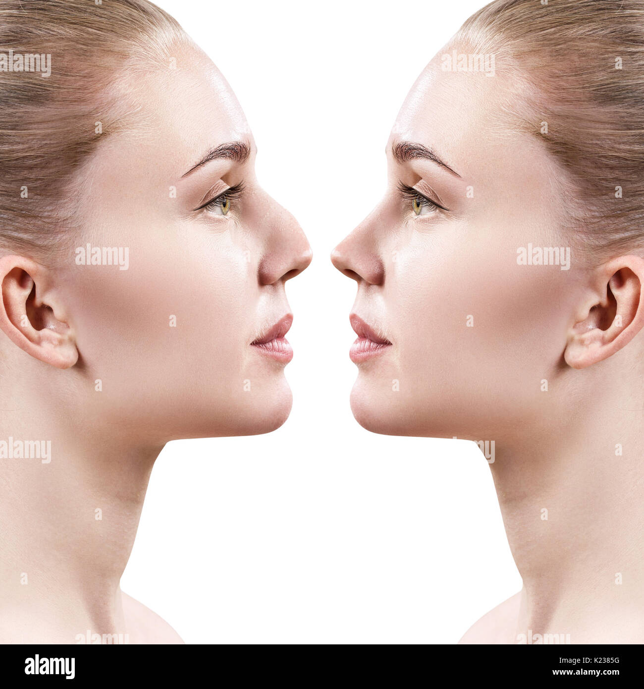 Weibliche Nase vor und nach der kosmetischen Chirurgie. Stockfoto