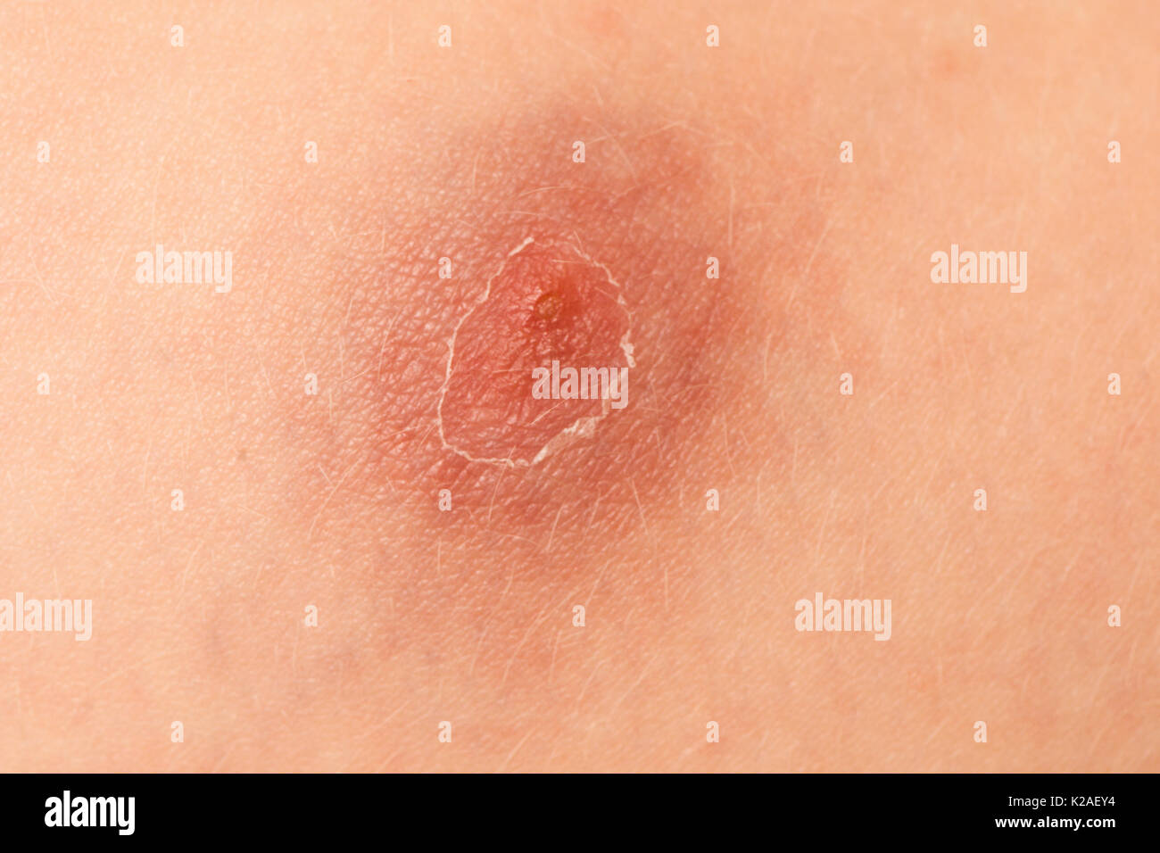 Wasser Warzen, Molluscum contagiosum, Virus, auf Boden eines fout jähriges Mädchen. Stockfoto