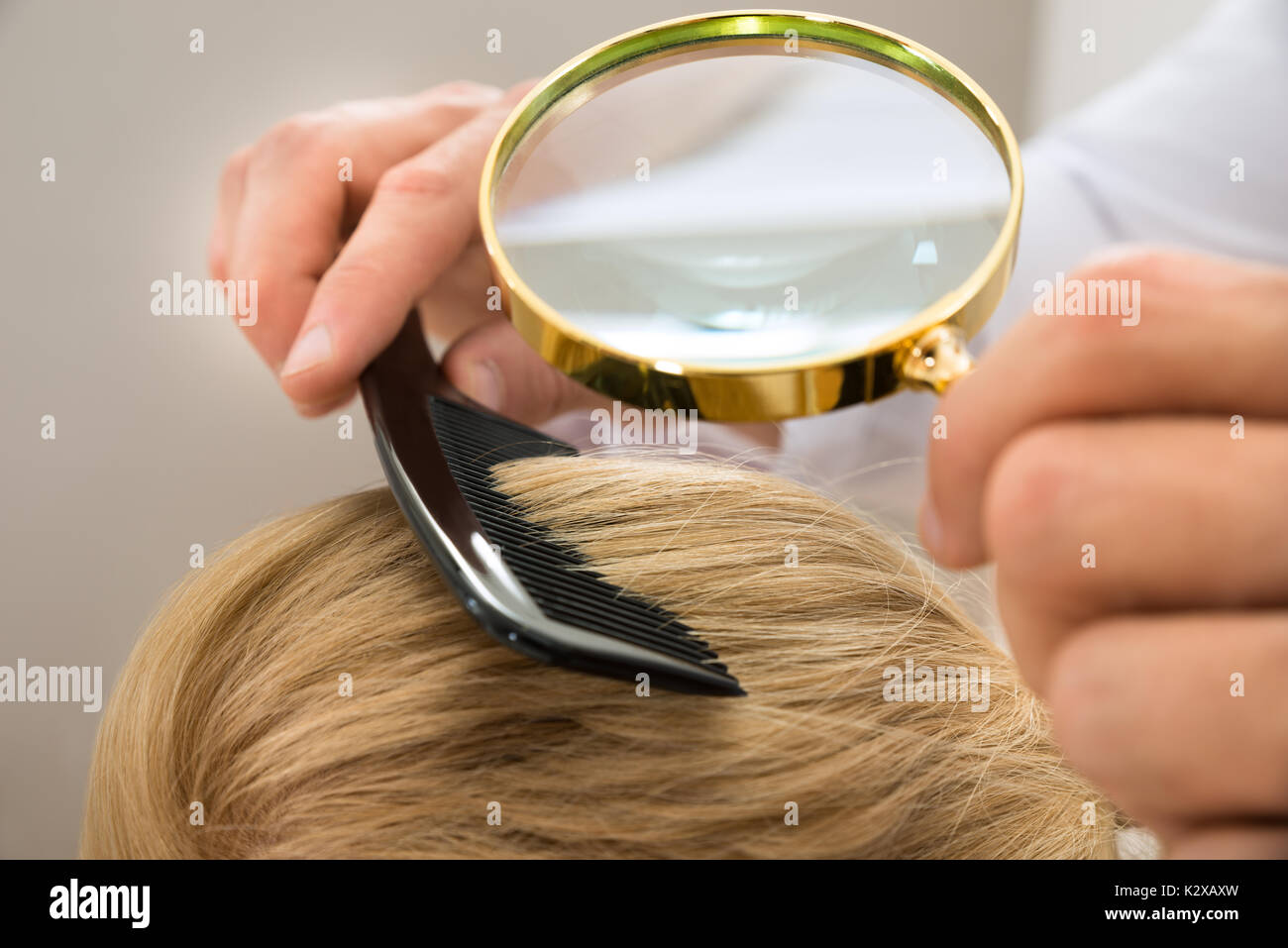 Close-up Hautarzt suchen beim Patienten zu blonden Haaren durch die Lupe Stockfoto