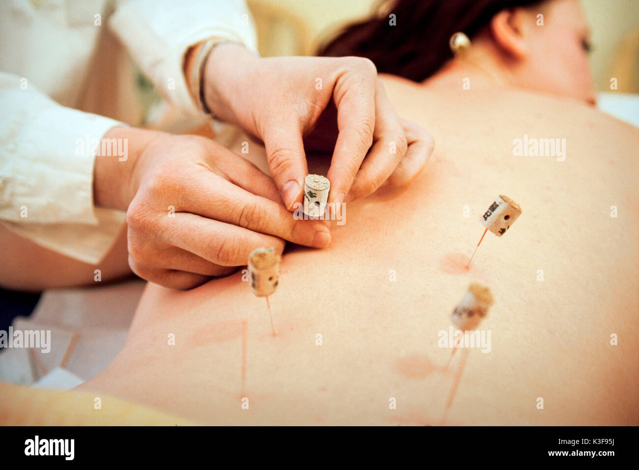 Akupunktur Traditionelle Chinesische Medizin Stockfoto