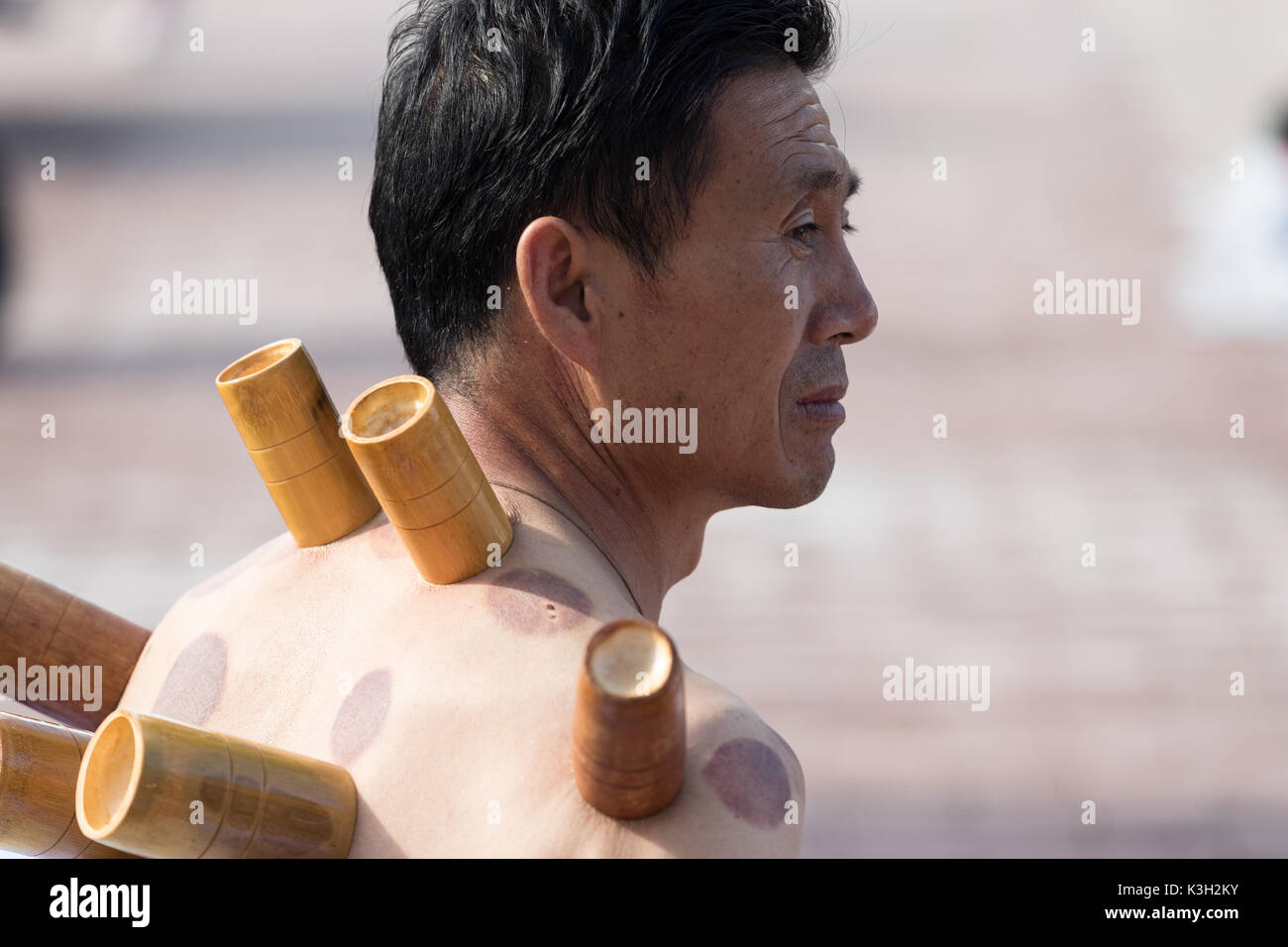 Cupping therapy Fotos und Bildmaterial in hoher Auflösung Alamy