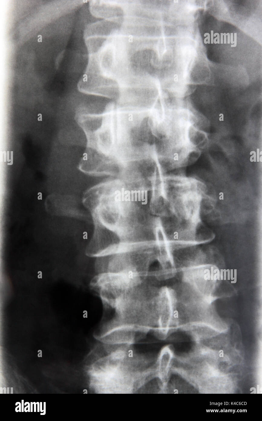 X-Ray von menschlichen Wirbel Stockfoto