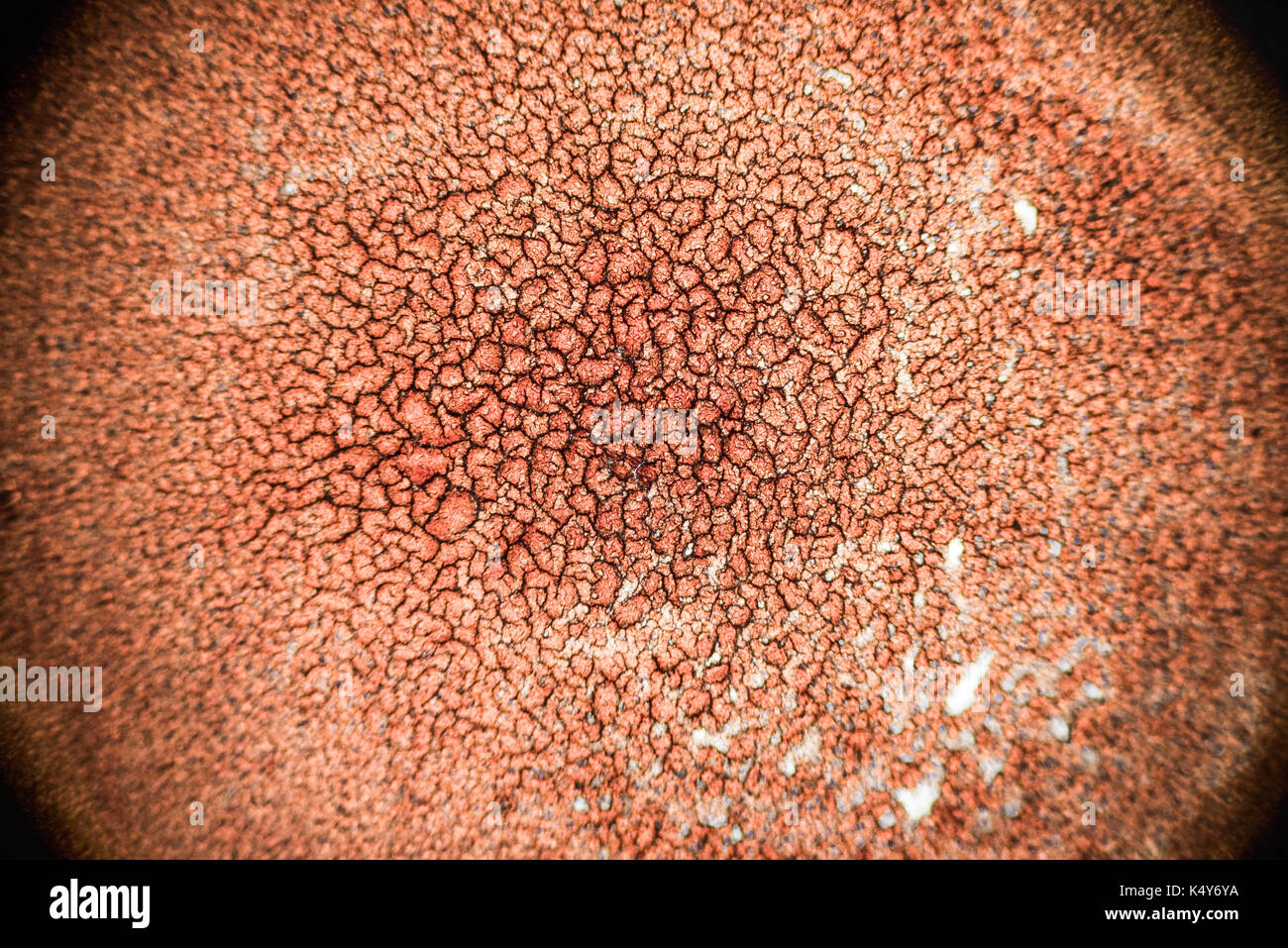 Verfestigte geronnenem Blut auf einer 100 x Mikroskop gesehen. Blutausstrich unter Mikroskop vorhanden Neutrophilen und roten Blutkörperchen Stockfoto