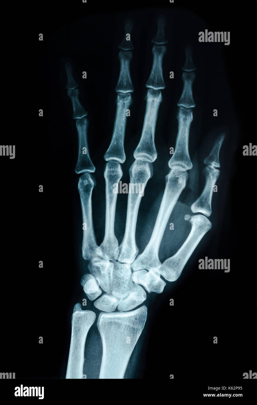 Hand x-ray Aussicht auf Schwarz. Stockfoto