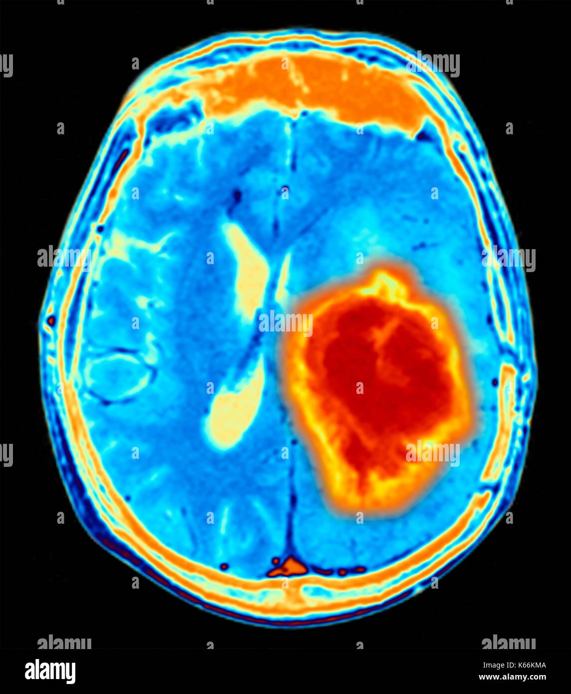 Hirntumor. Farbige Magnetresonanztomographie (MRT) Scan eines axialen Schnitt durch das Gehirn mit einem metastasierten Tumor. Unten links ist der Tumor (rot-gelb) Dieser Tumor innerhalb einer Gehirnhälfte erfolgt ist; die andere Hemisphäre ist auf der rechten Seite. Die Augäpfel - nicht sichtbar - sind oben. Metastasierendem Krebs ist eine Krankheit, die vom Krebs an anderer Stelle im Körper. Metastasierendem malignen Hirntumoren sind. In der Regel verursachen Sie Gehirn Kompression und Nervenschäden Stockfoto