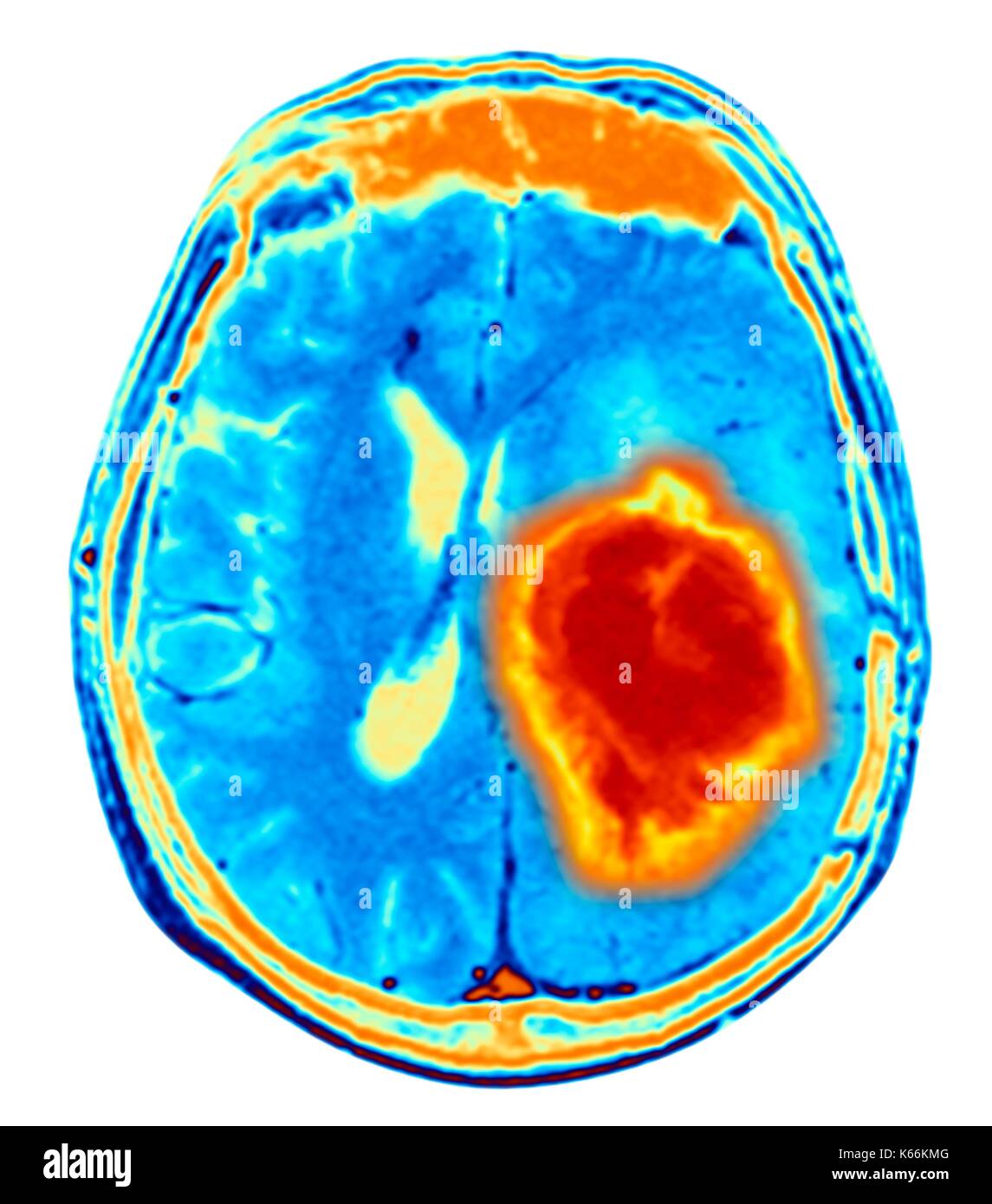 Hirntumor. Farbige Magnetresonanztomographie (MRT) Scan eines axialen Schnitt durch das Gehirn mit einem metastasierten Tumor. Unten links ist der Tumor (rot-gelb) Dieser Tumor innerhalb einer Gehirnhälfte erfolgt ist; die andere Hemisphäre ist auf der rechten Seite. Die Augäpfel - nicht sichtbar - sind oben. Metastasierendem Krebs ist eine Krankheit, die vom Krebs an anderer Stelle im Körper. Metastasierendem malignen Hirntumoren sind. In der Regel verursachen Sie Gehirn Kompression und Nervenschäden Stockfoto
