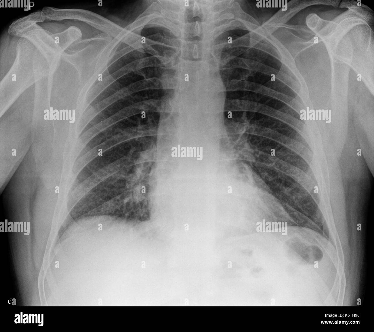 Ein x-ray des Körpers und der Wirbelsäule und Nacken Stockfoto