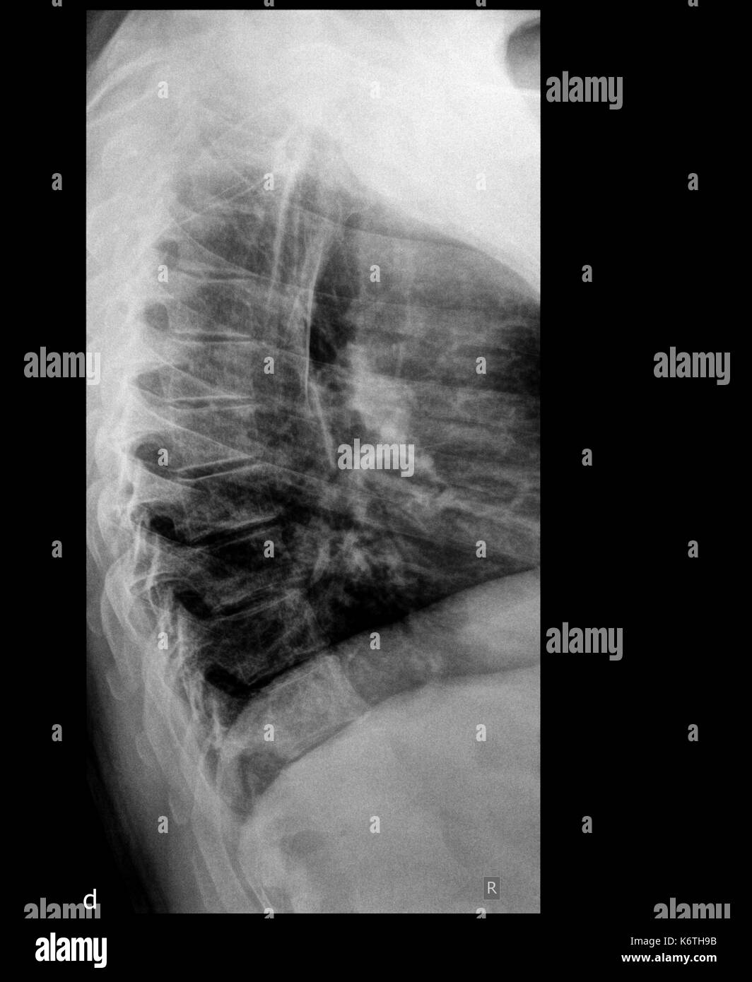 Ein x-ray des Körpers und der Wirbelsäule und Nacken Stockfoto