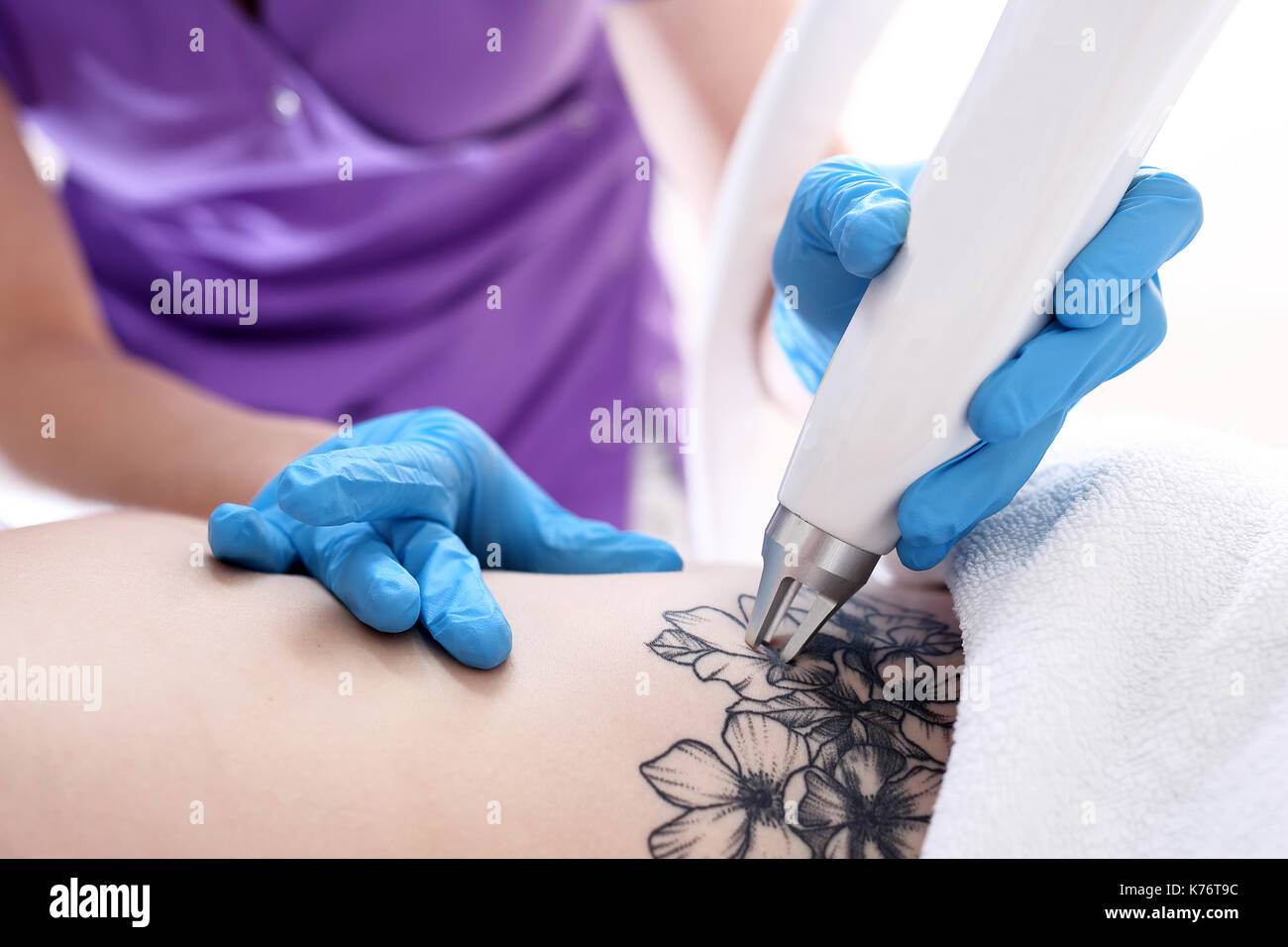 Laser Tattooentfernung in der kosmetischen Chirurgie. Laser Tattooentfernung in der Klinik für ästhetische Medizin. Stockfoto