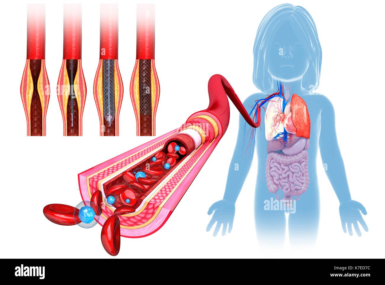 Abbildung: eine blockierte Arterie durch Stent Angioplasty behandelt wird. Stockfoto