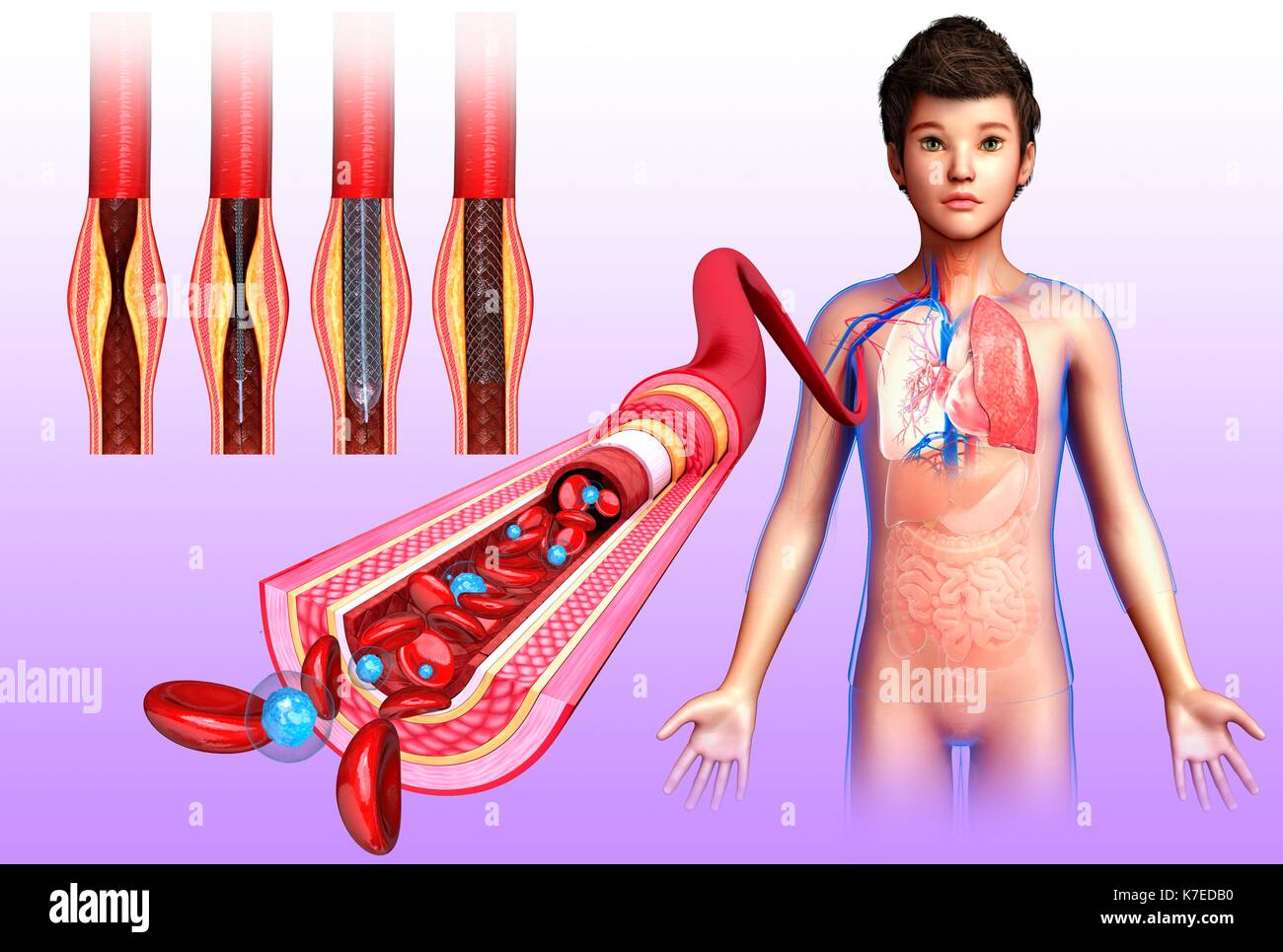 Abbildung: eine blockierte Arterie durch Stent Angioplasty behandelt wird. Stockfoto