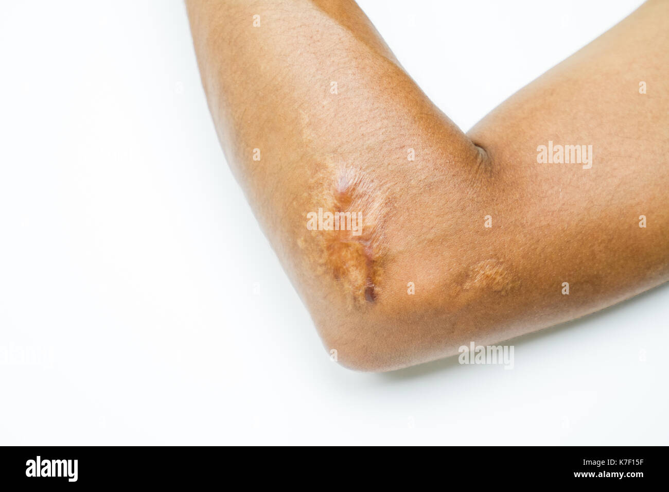 Closeup keloid Narbe an der Winkelverschraubung von asiatischer Mann haut nach Motorradunfall auf weißem Hintergrund mit kopieren. Stockfoto