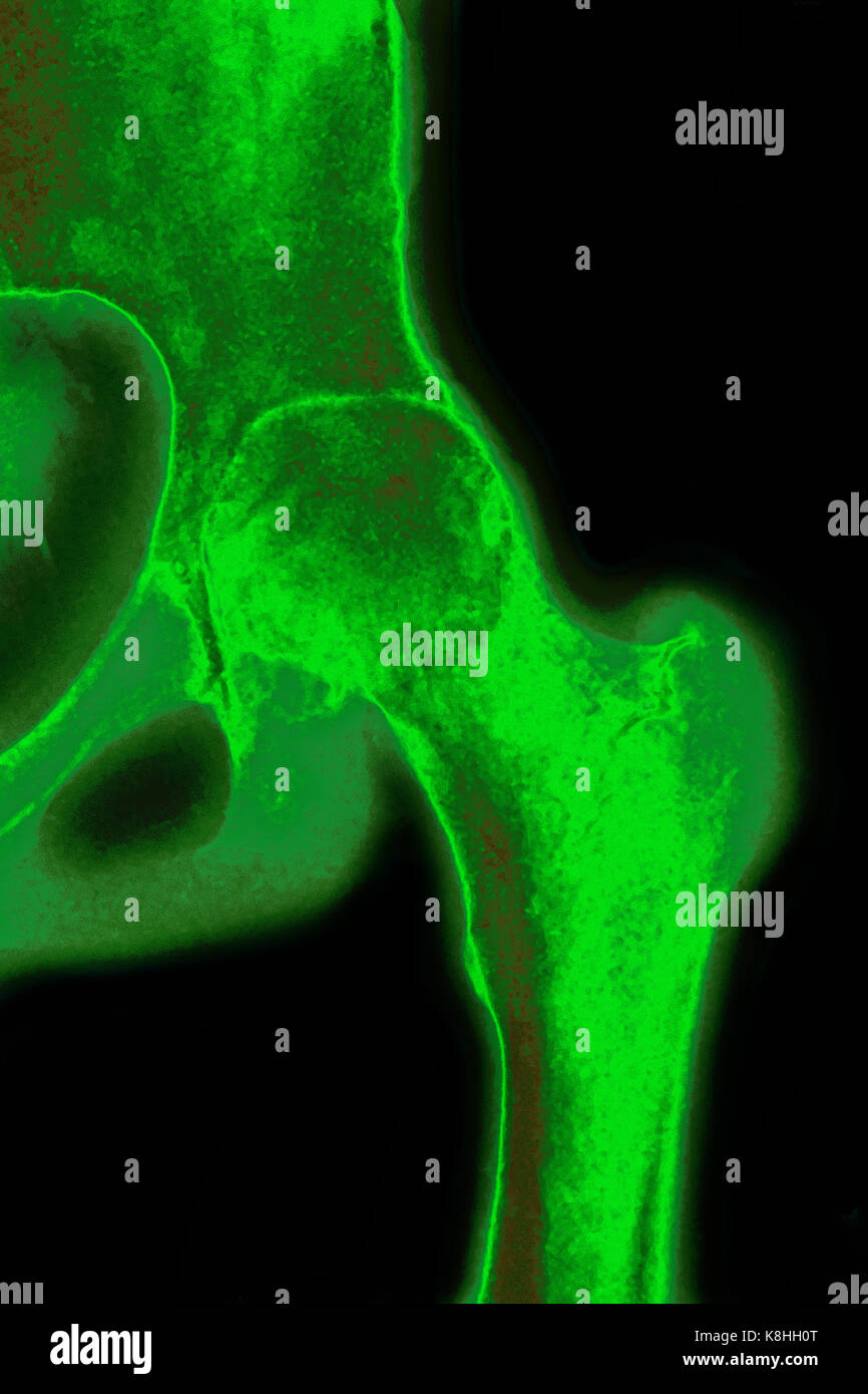 HIP ARTHROSE, X-RAY Stockfoto