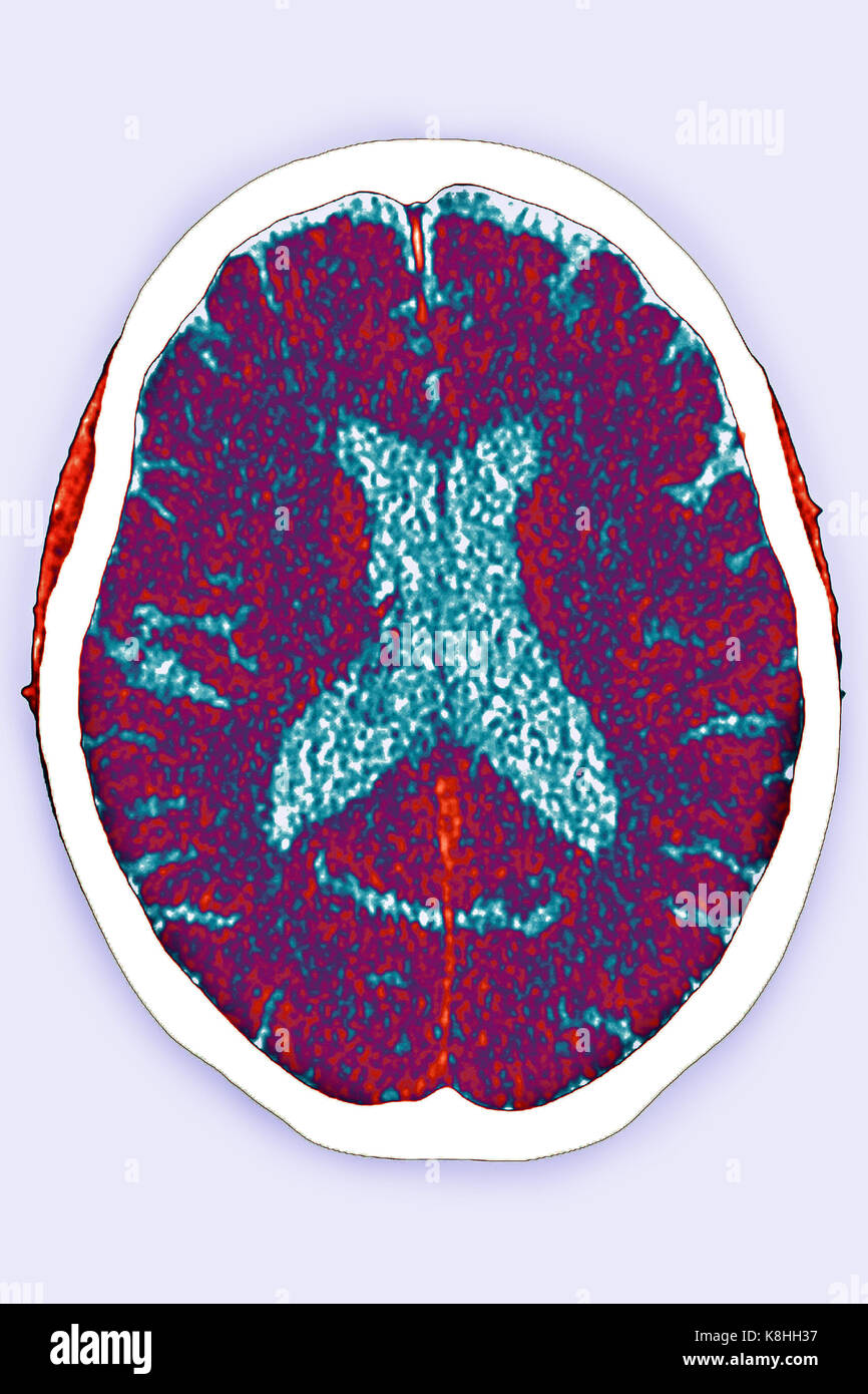 ZEREBRALE ATROPHIE, CT-SCAN Stockfoto