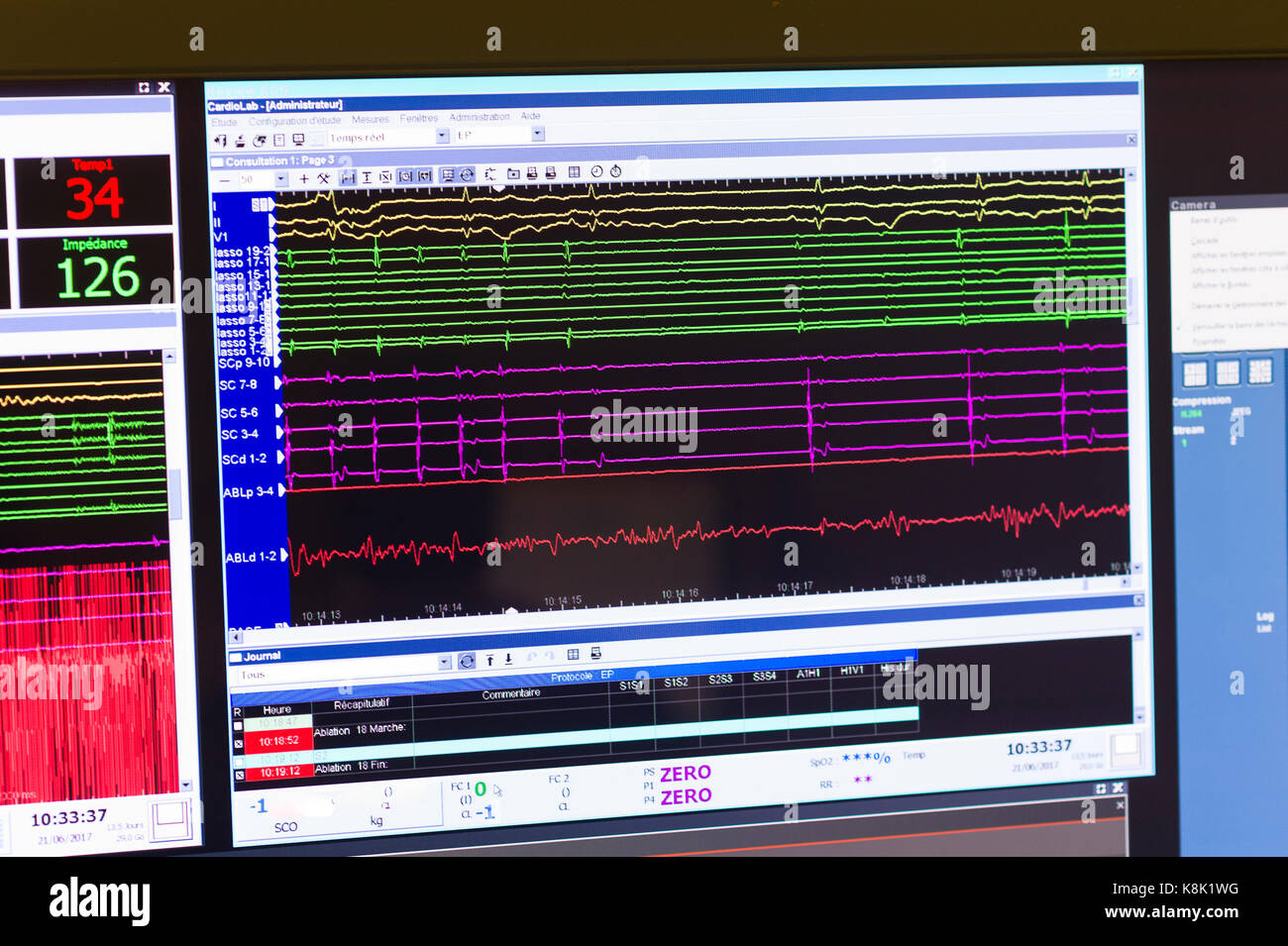 RADIOFREQUENZ-ABLATION Stockfoto