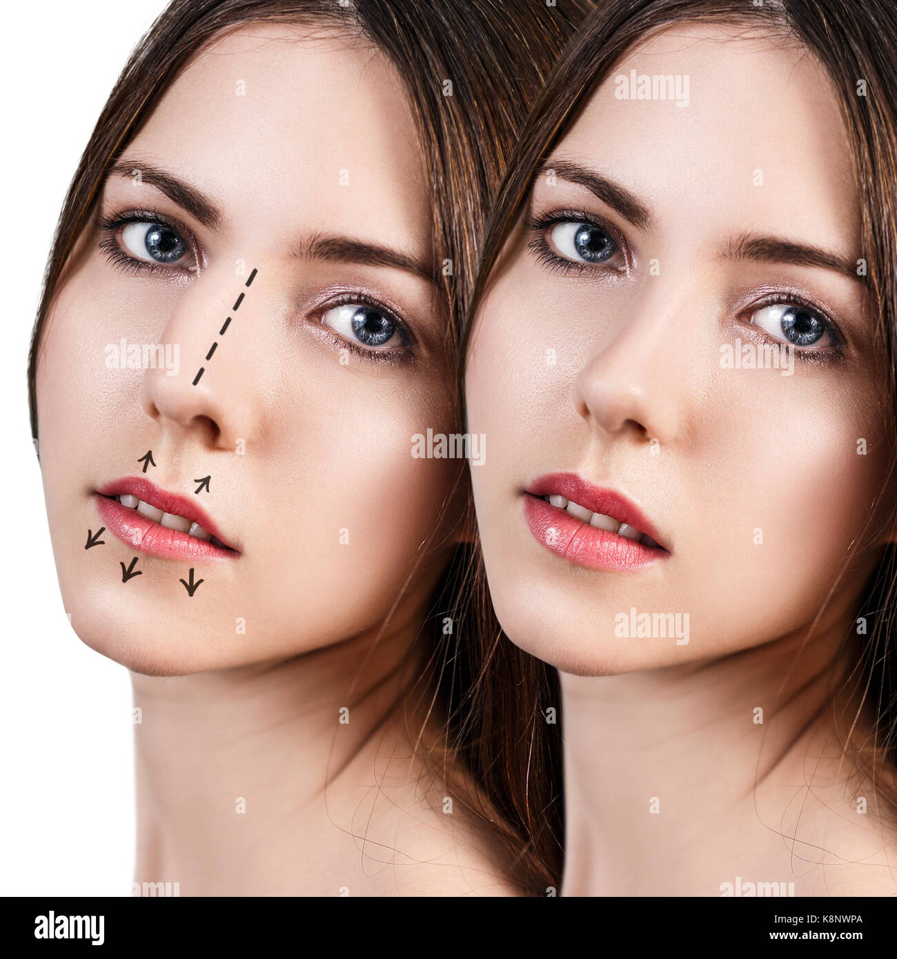 Weibliche Nase vor und nach der kosmetischen Chirurgie Stockfoto