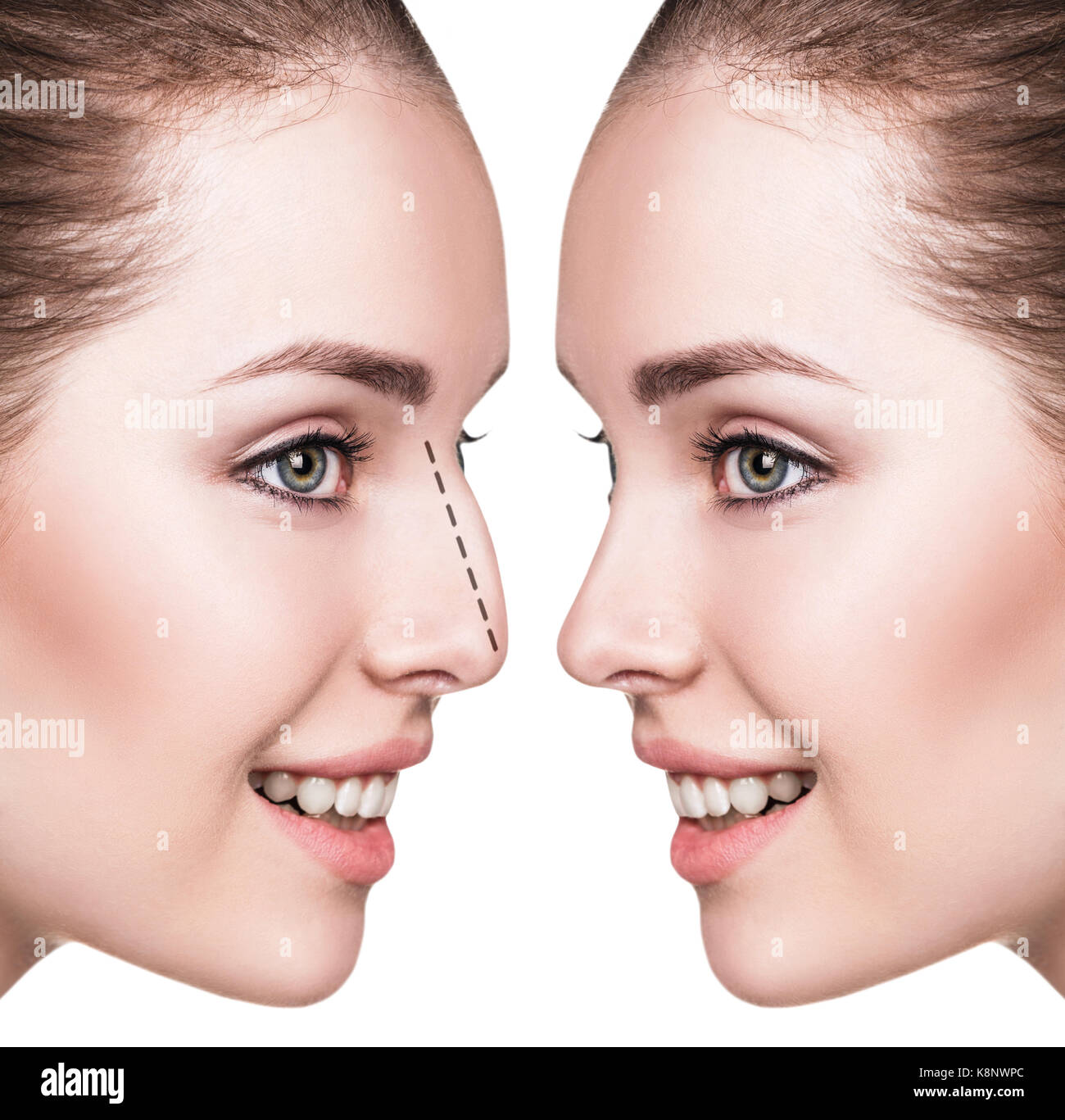 Weibliche Nase vor und nach der kosmetischen Chirurgie Stockfoto