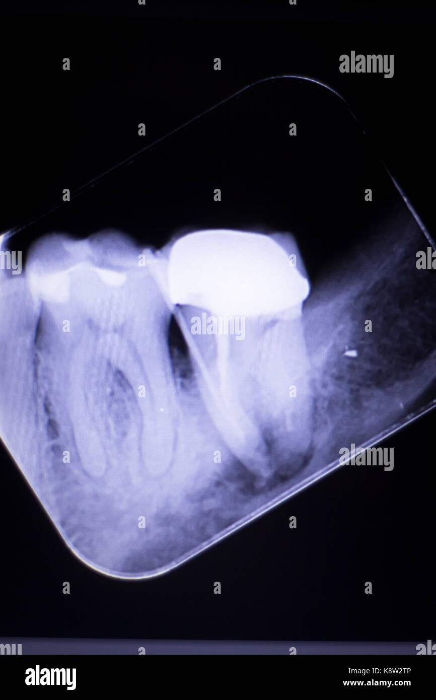 Dental xrayScan der Zahn mit Krone füllen und Wurzelbehandlung Infektion Entzündung der